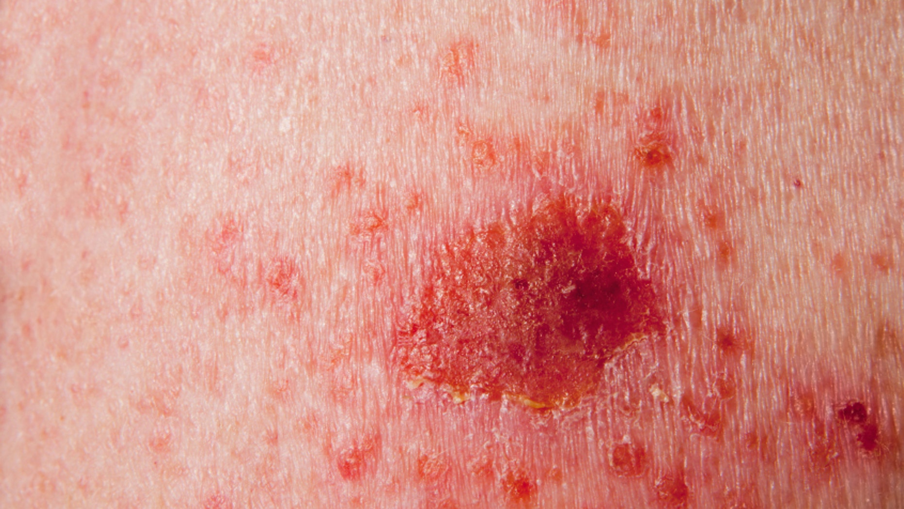 pictures of skin cancers