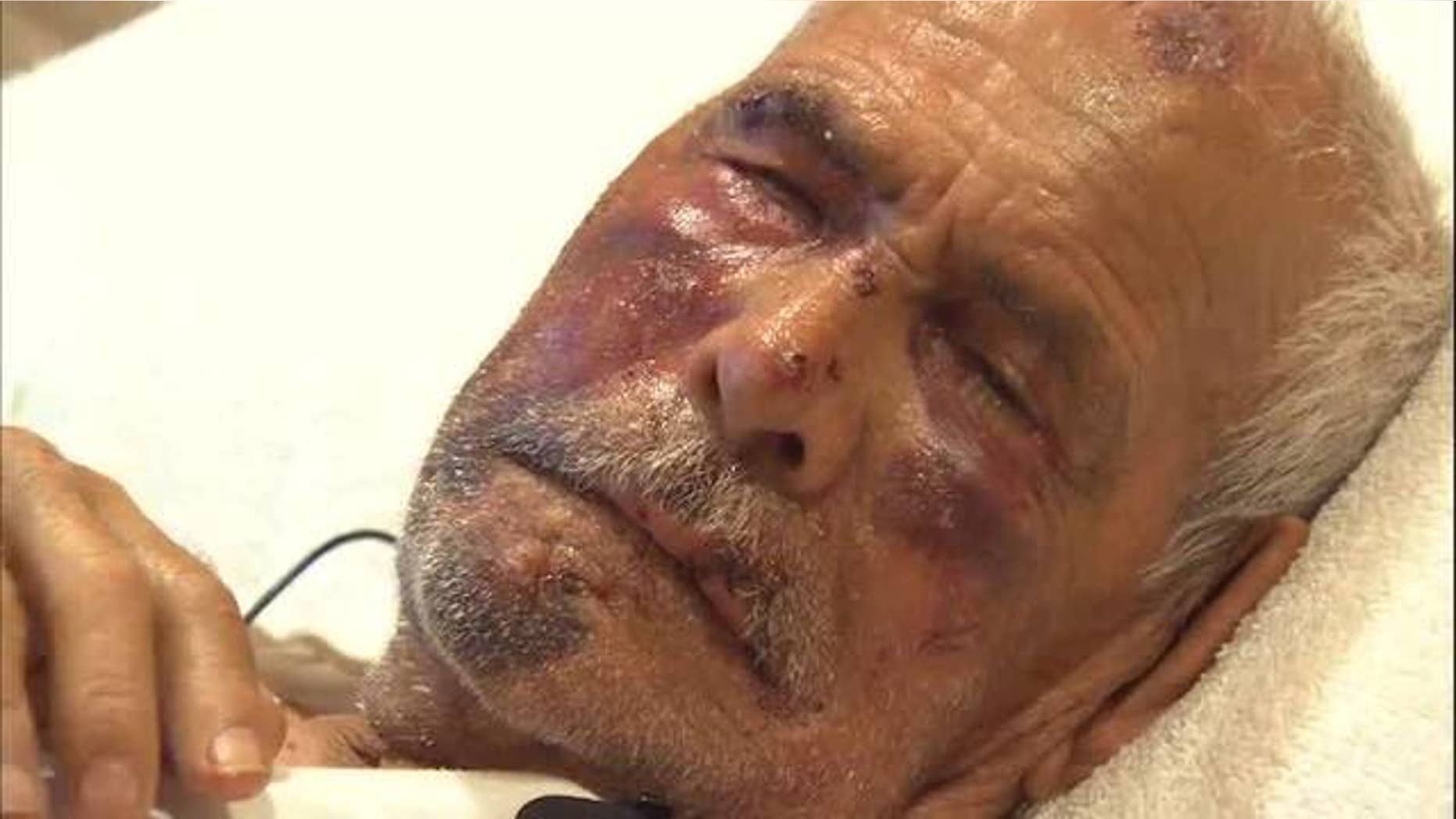 Rodolfo Rodriguez, 92, was beaten in the face with a break and stomped on during an attack on July 4.
