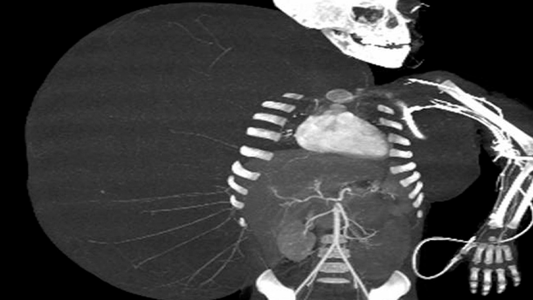 In this still image taken from an undated video released by the Mexican Social Security Institute (IMSS) on Tuesday, June 26, 2012, an image created through medical imaging technology shows an X-ray-like image of 2-year-old Jesus Rodriguez, prior to having a benign tumor removed from his body.