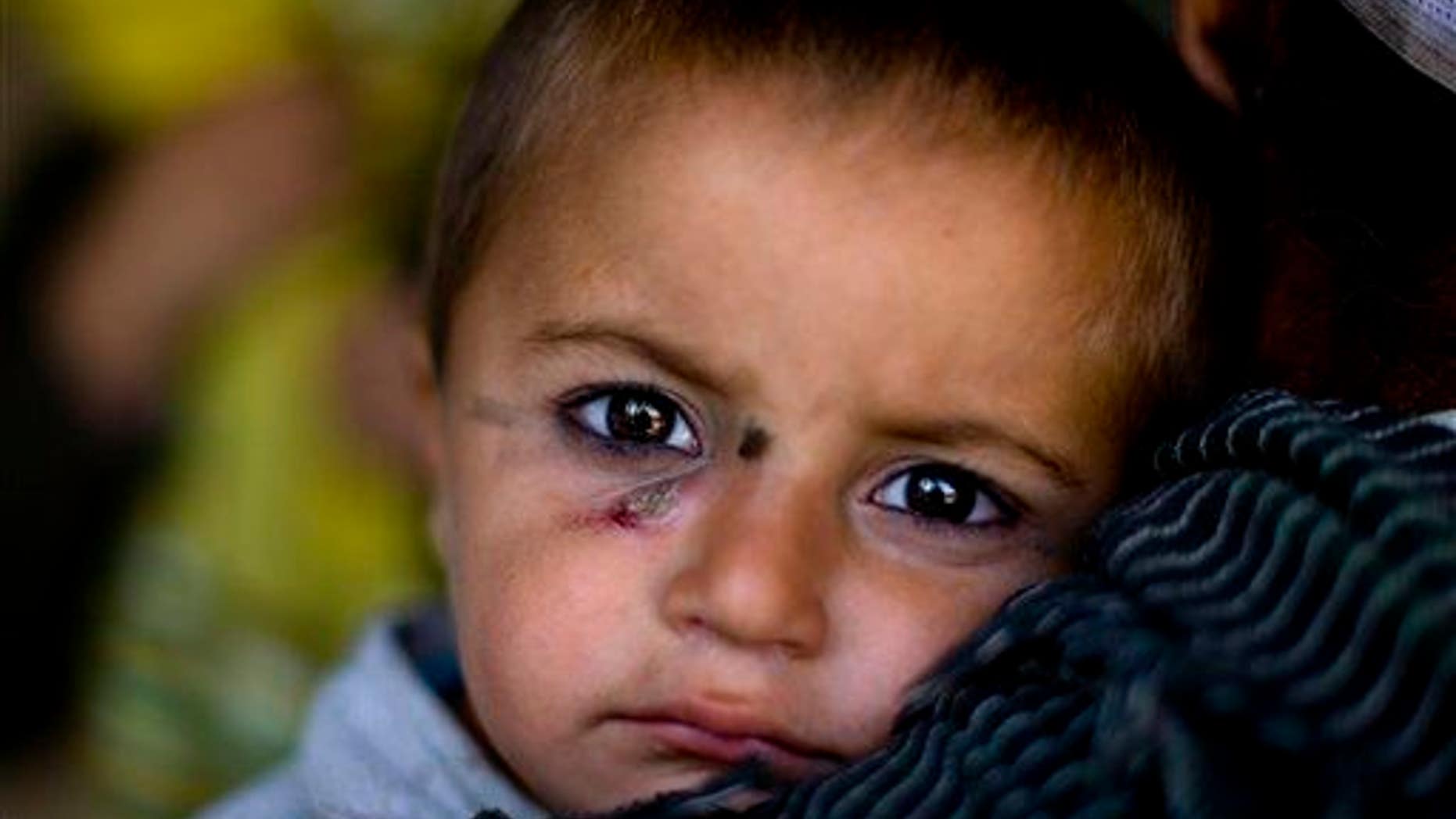 An Afghan boy affected by leishmaniasis waits to be seen by a doctor Monday in Kabul, Afghanistan.