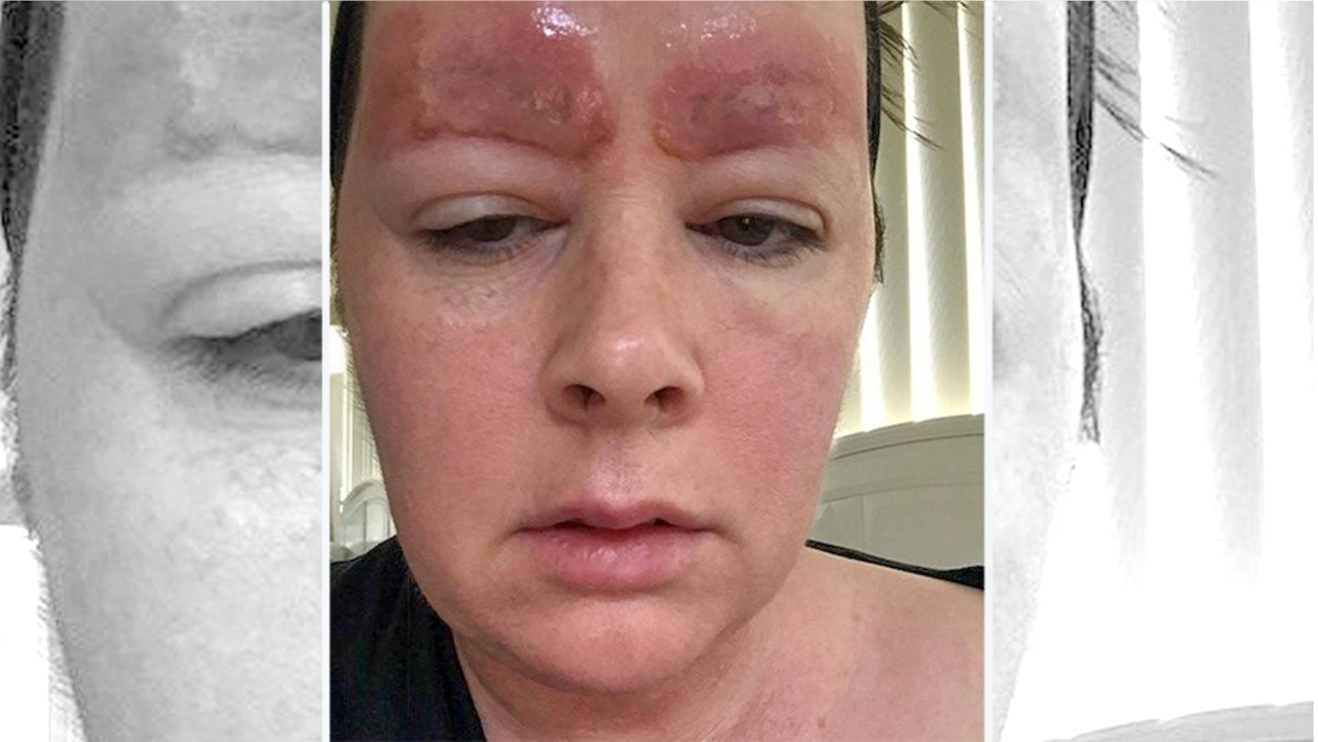 Amanda Coates is being sued by the clinic that did her eyebrow tattoos, which she claims caused a terrible reaction.