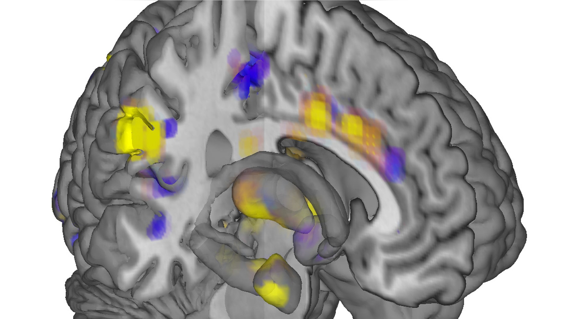 Activity in yellow-colored areas is predictive of higher levels of pain, and activity in blue-colored areas is predictive of lower levels of pain. (AP Photo/University of Colorado, Boulder, Tor Wager)