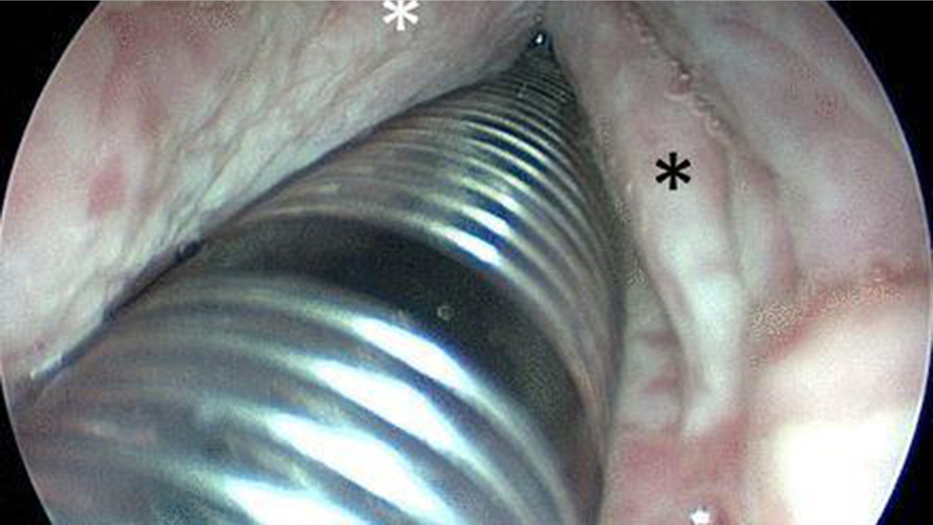 The white areas marked with an asterisk show the areas that began to rot after the unidentified man swallowed bleach thinking it was a painkiller.