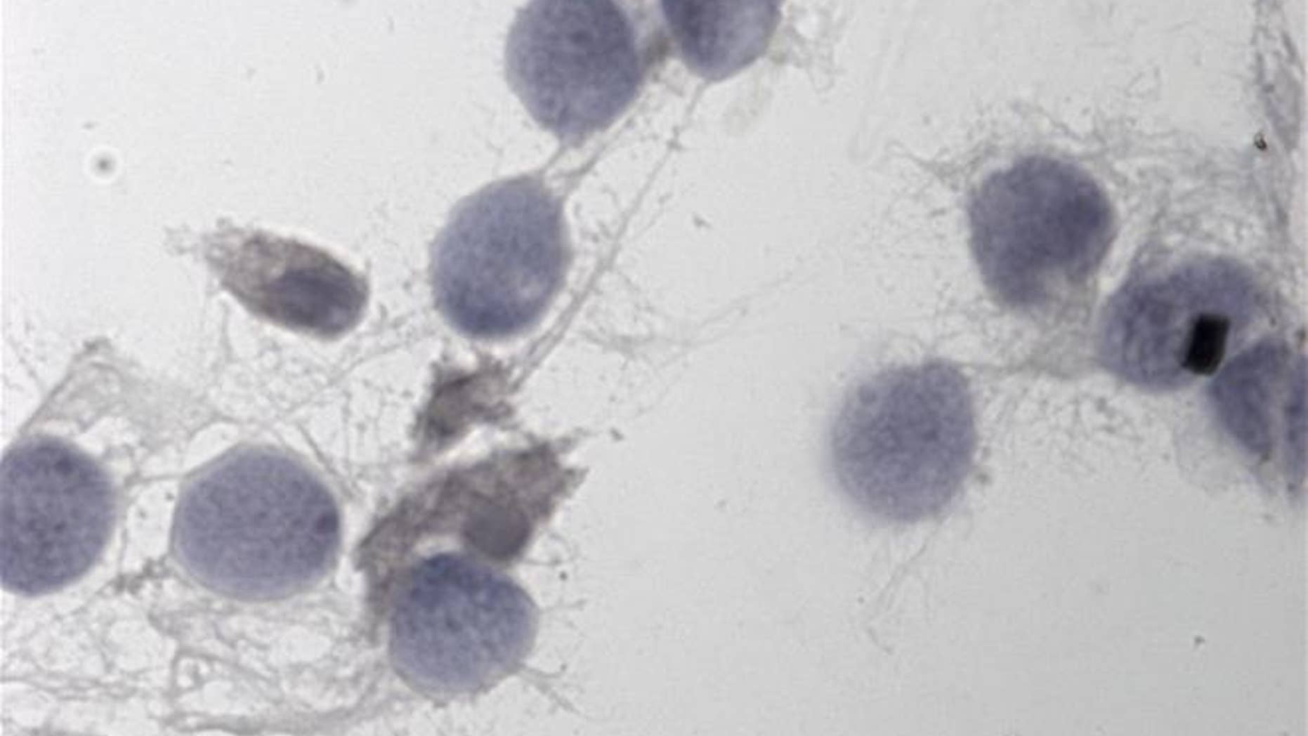 Boys conceived via a particular fertility technique may inherit their father's poor sperm.