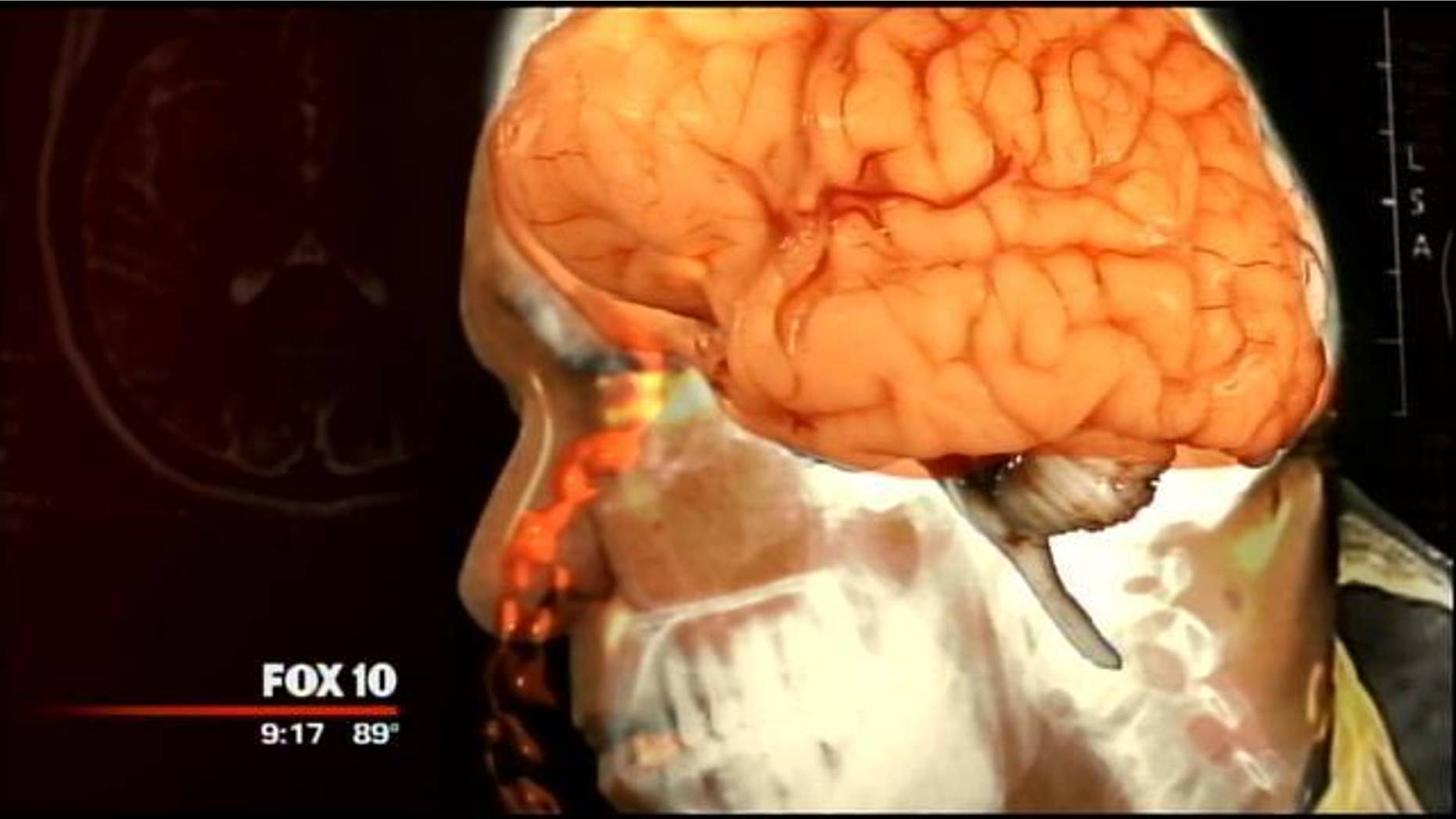 An image of Joe Nagy's brain, which was leaking fluid through his nose.