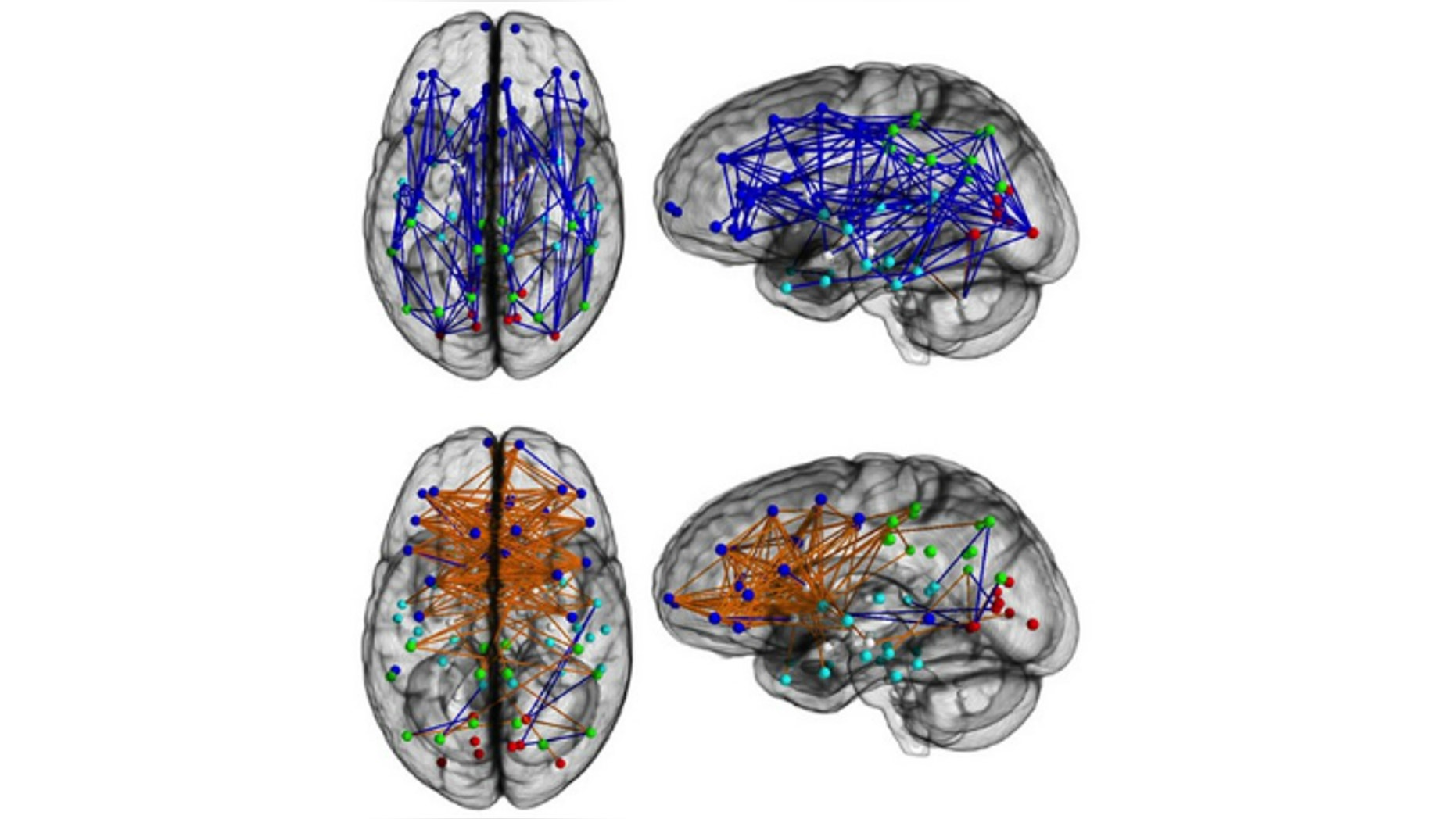 Brain networks showing significantly increased intra-hemispheric connectivity in males (Upper) and inter-hemispheric connectivity in females (Lower). Intra-hemispheric connections are shown in blue, and inter- hemispheric connections are shown in orange.