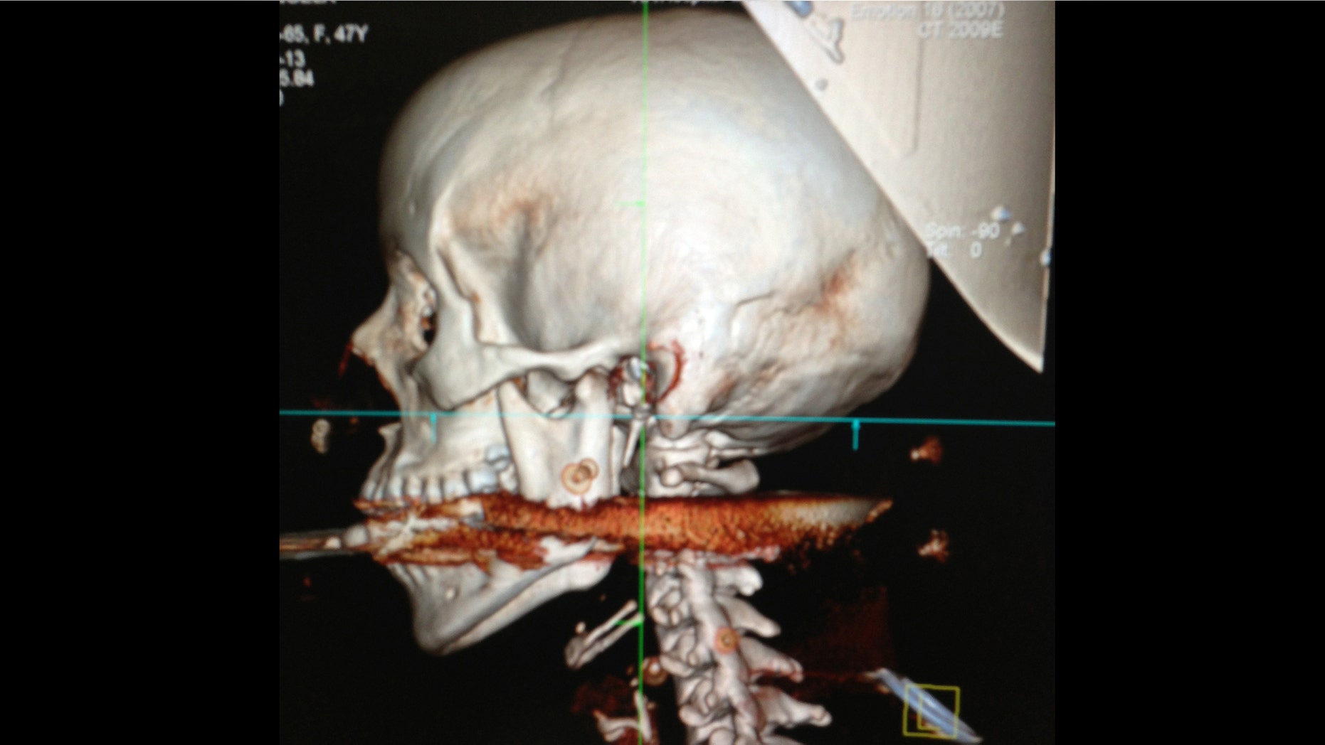 This May 6, 2013 image released Wednesday, May 8, 2013, by Rio de Janeiro State Health Department, shows the spear that was accidentally shot through the mouth of Elisangela Borborema Rosa, in the coastal city of Arrial do Cabo, Brazil. (AP Photo/Rio de Janeiro State Health Department)