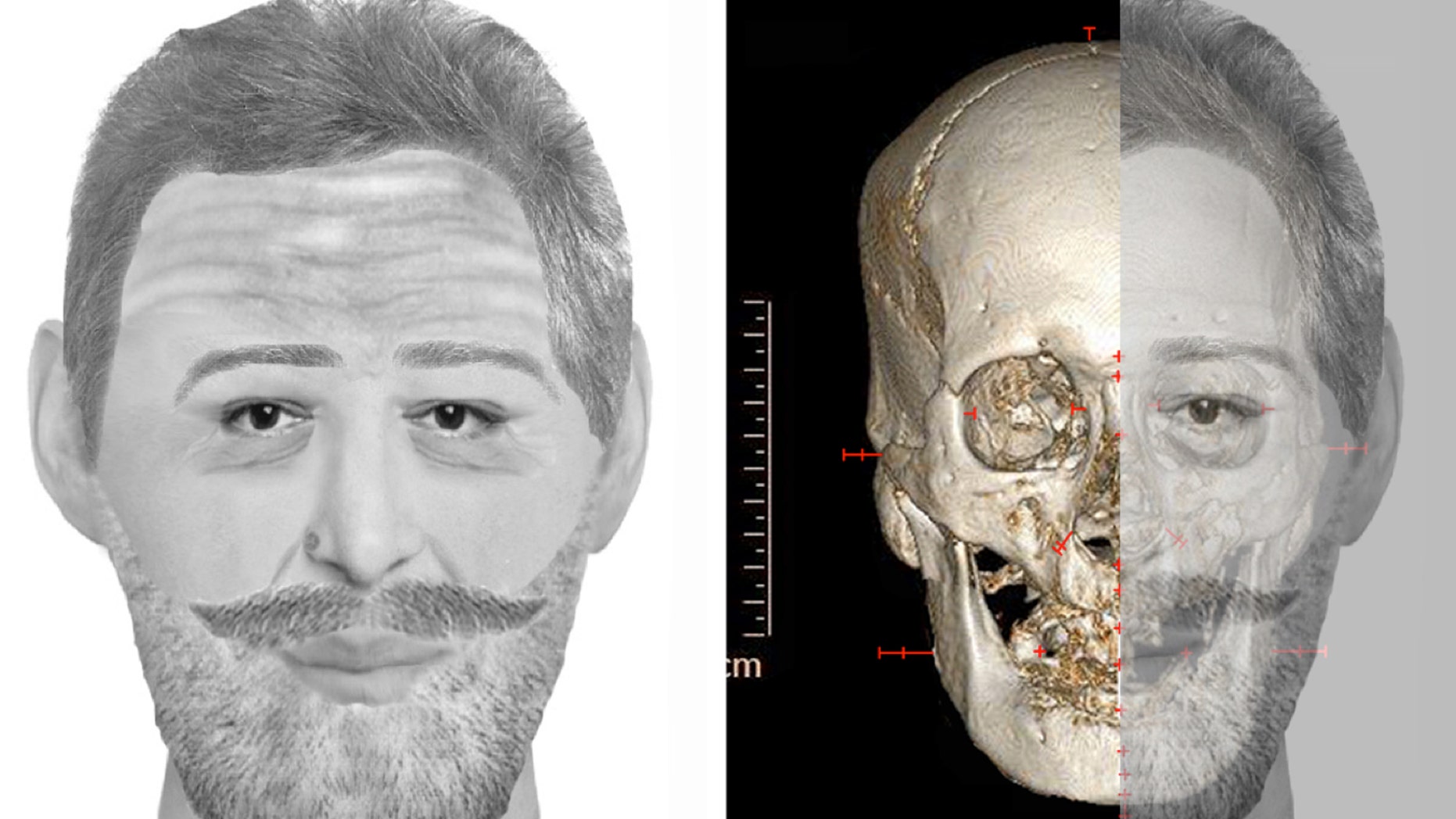 Dec. 15: In this combination digital image made available by Jean-Noel Vignal and Isabelle Huynh-Charlier, a reconstruction of the face France's King Henri IV is seen, left, and his skull with the reconstruction overlaid is seen at right.