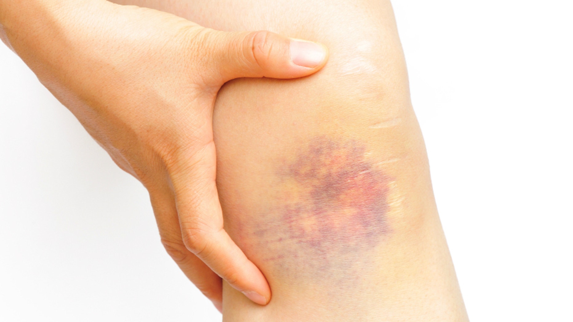 7 Odd Reasons You Bruise Easily | Fox News