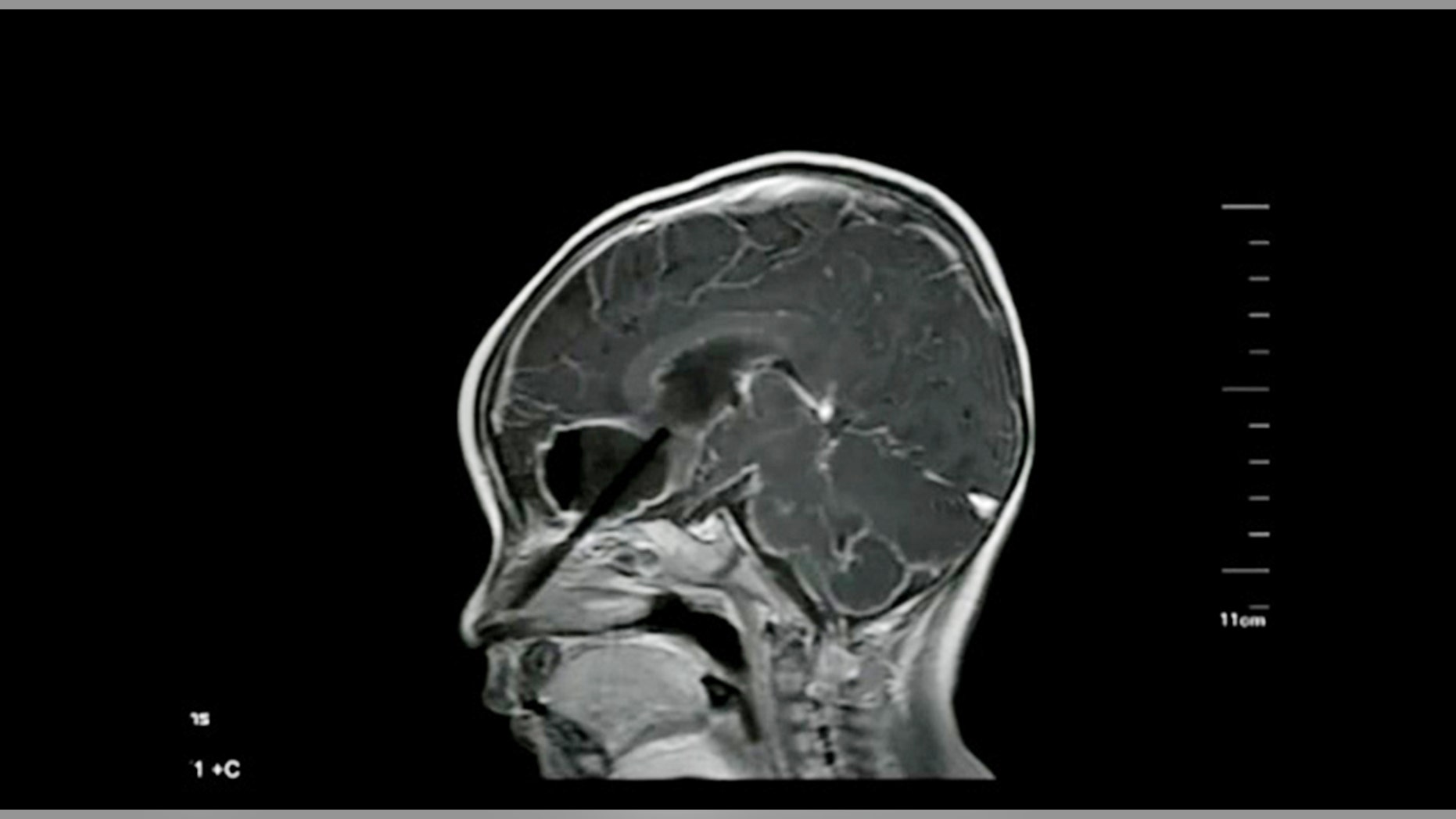 A baby who got a chopstick stuck up his nose which punctured his brain and caused an infection was taken to hospital 10 days later - because his parents didn't notice.