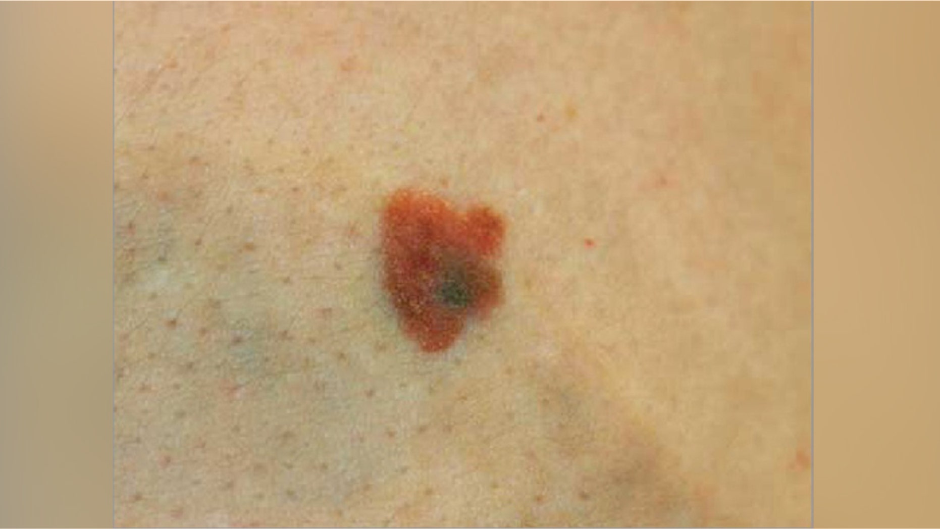 A photograph of the cancerous mole.