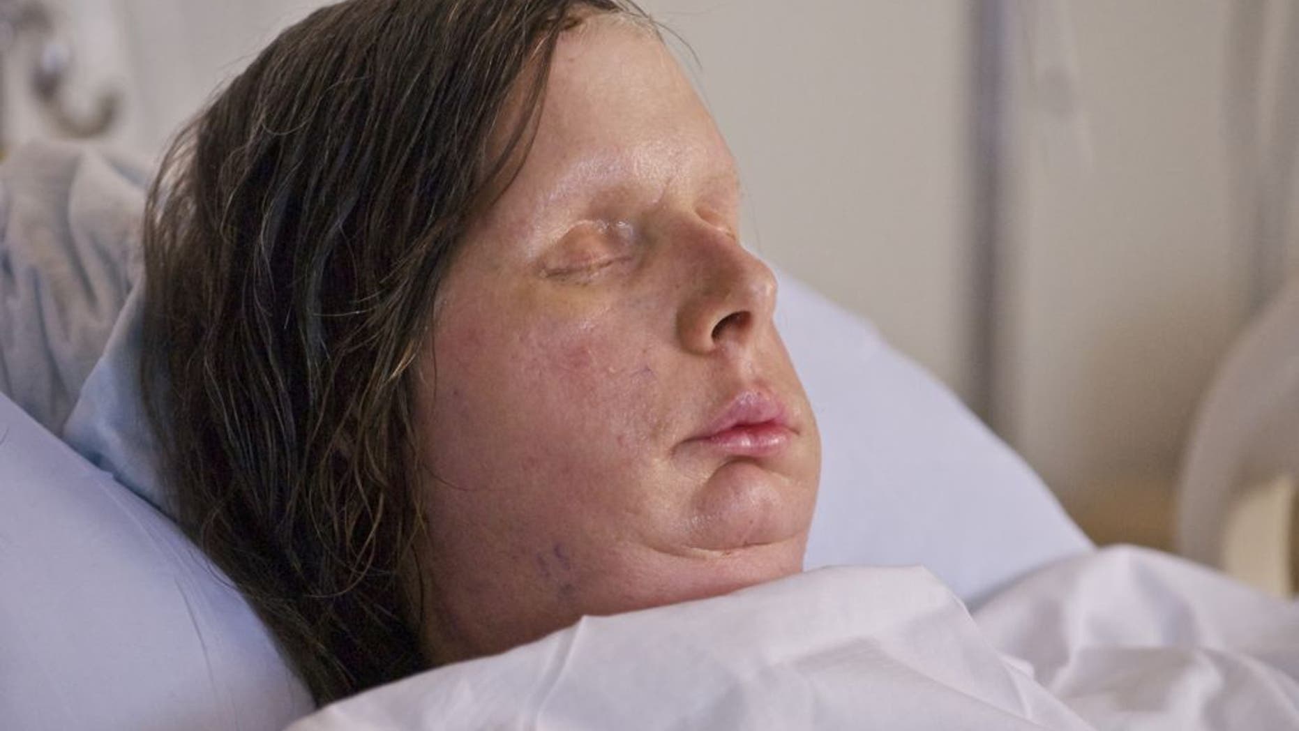 Charla Nash, after a full face transplant at Brigham and Women's Hospital.