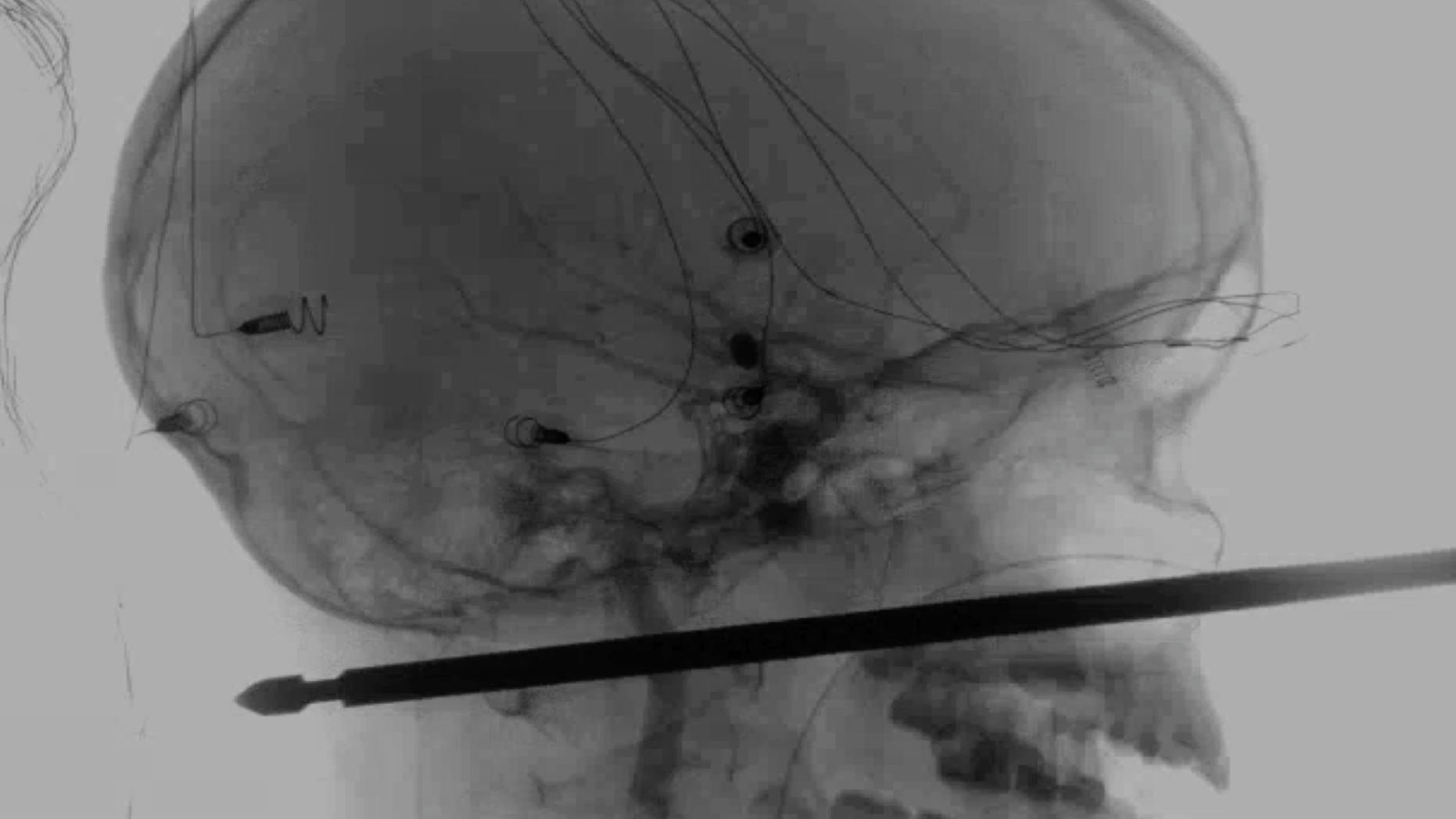 This X-ray provided by the Medical News Network shows a meat skewer impaled in the skull of Xavier Cunningham after an accident at his home Saturday, Sept. 8, 2018, in Harrisonville, Mo. Cunningham's experience began when yellow jackets attacked him in a tree house and he tumbled from the tree, landing on the skewer. The skewer had completely missed the boy's eye, brain, spinal cord and major blood vessels and doctors think he could recover completely. (Medical News Network via AP)