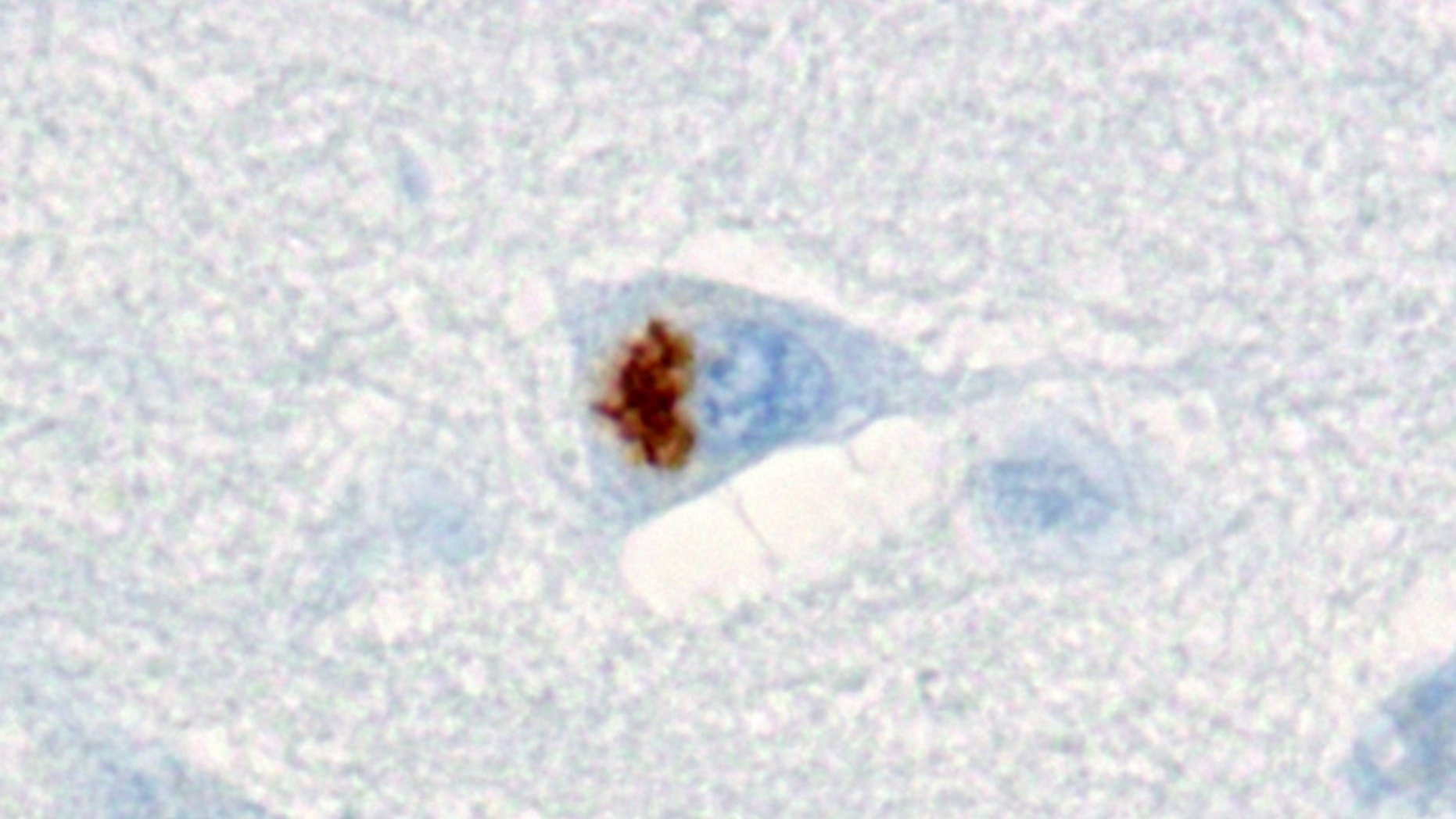 A protein clump (brown) in the hippocampus in the brain of a person with a gene mutation linked to dementia. Credit: Kohji Mori and Dieter Edbauer
