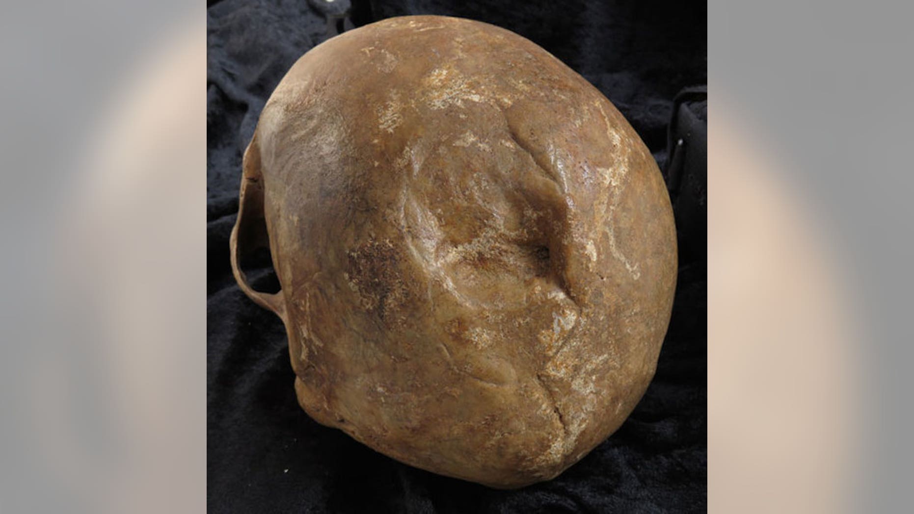 The smooth edges of this skull fracture suggest that the injury healed after the skull's owner, a man buried in Odense, Denmark, was hurt.