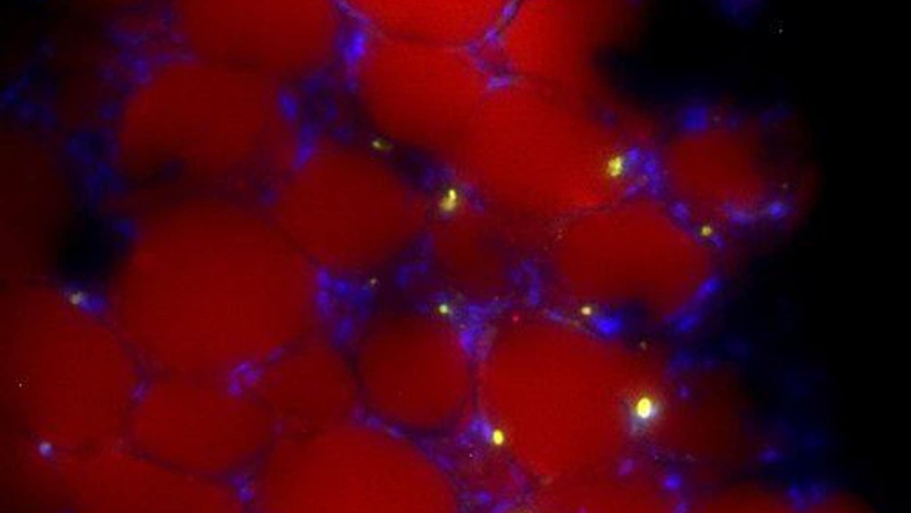 A treatment using "disabled" HIV helped put a man's cancer in remission.
