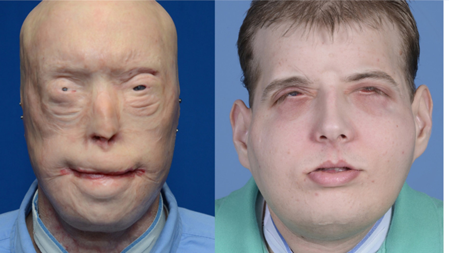 This combination of photos provided by the New York University Langone Medical Center shows Patrick Hardison before and after his facial transplant surgery in New York.