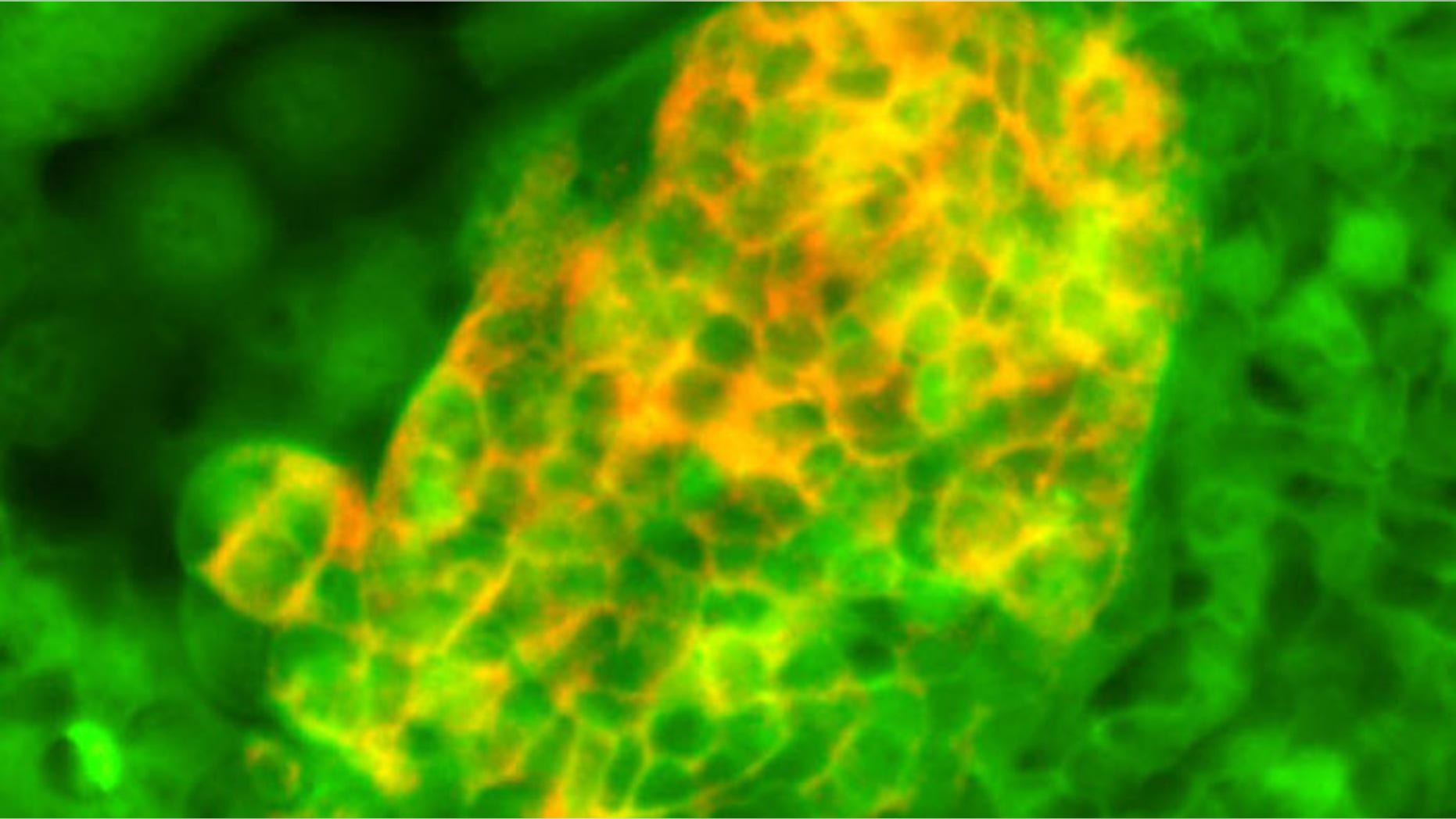 Foregut stem cells (green) differentiated into pancreatic cells expressing insulin.