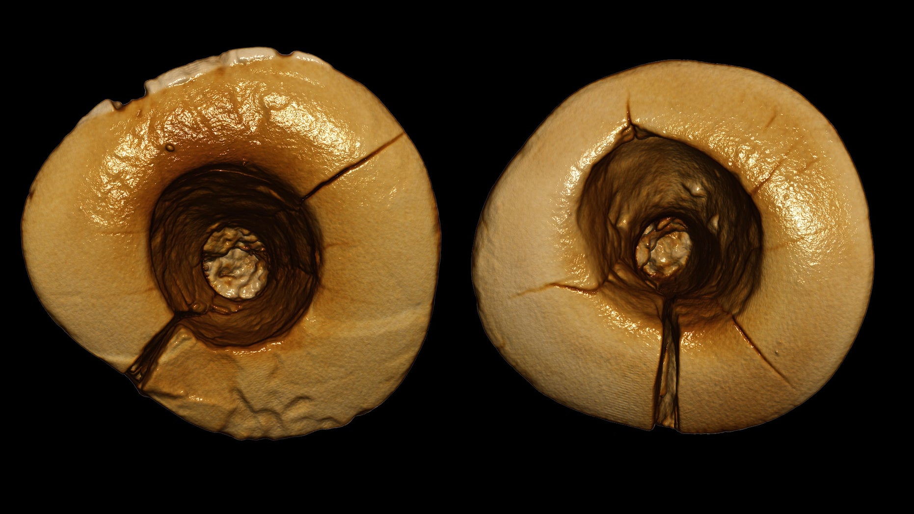 Archaeologists discovered a 13,000-year-old skeleton with two front teeth that have big holes in the surface that reach down to the tooth's pulp chamber.