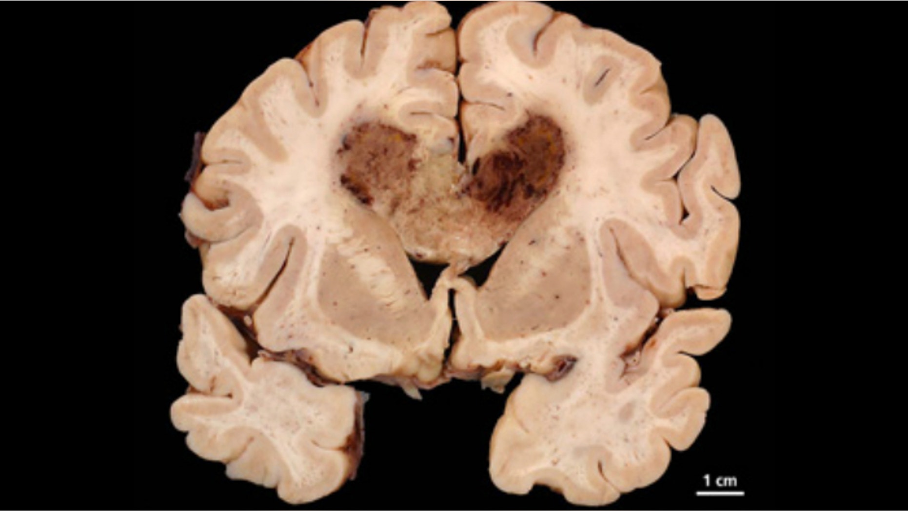 This image shows a human brain specimen with glioblastoma multiforme.