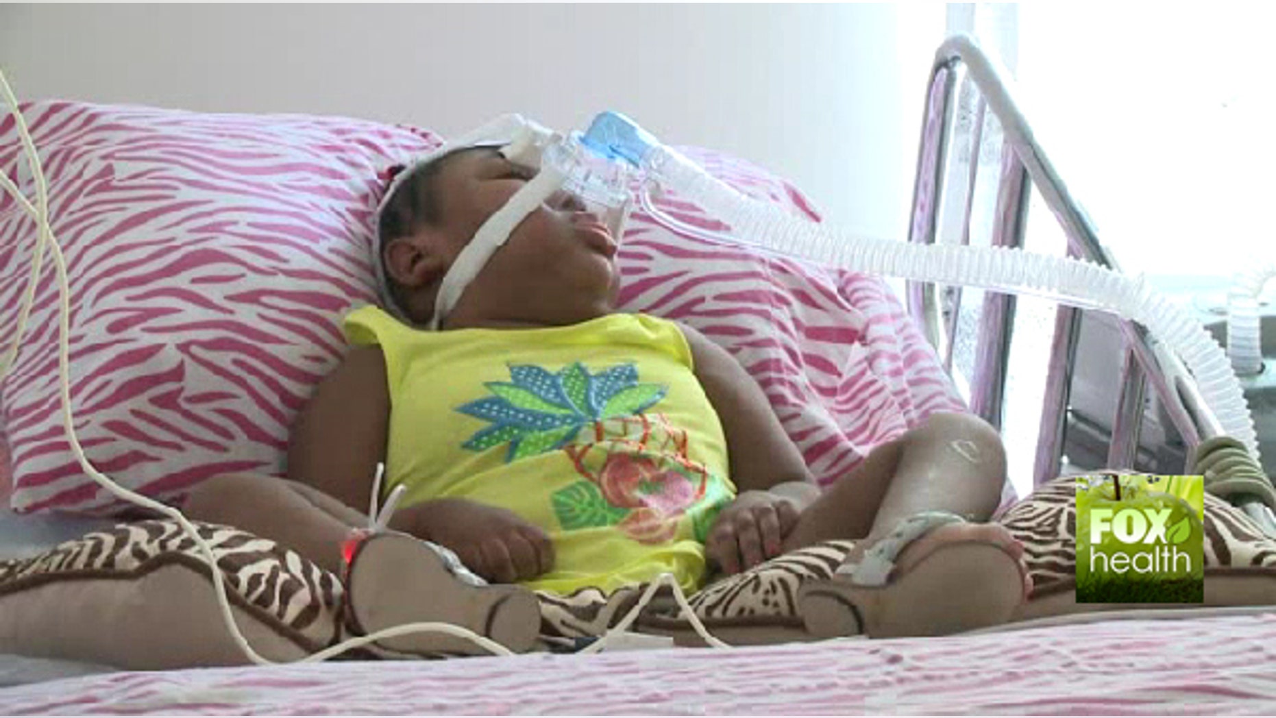 Kaliysha, 6, shown here, was born without a brain.