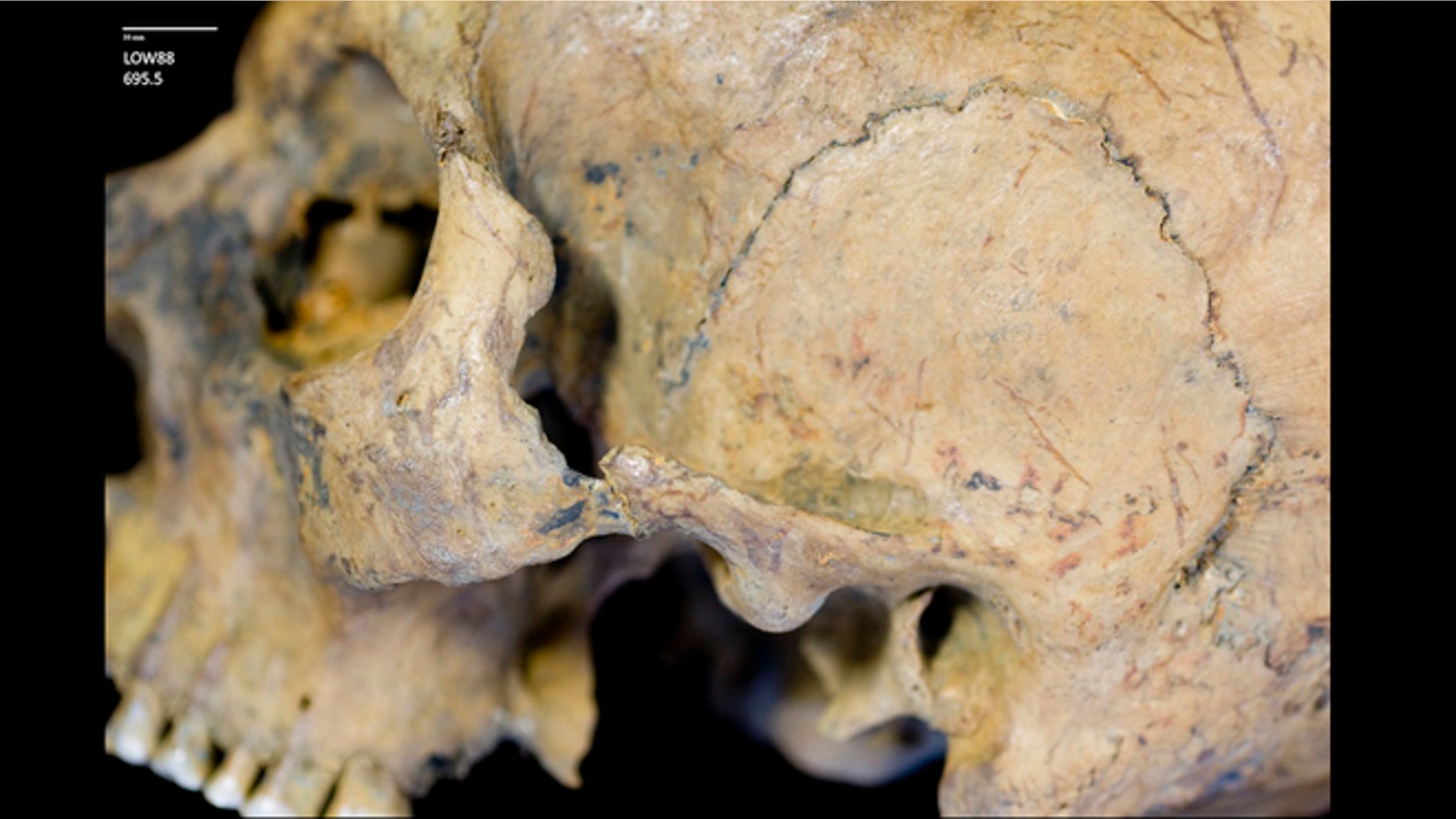 One of the skulls had a healed fracture in its cheek.