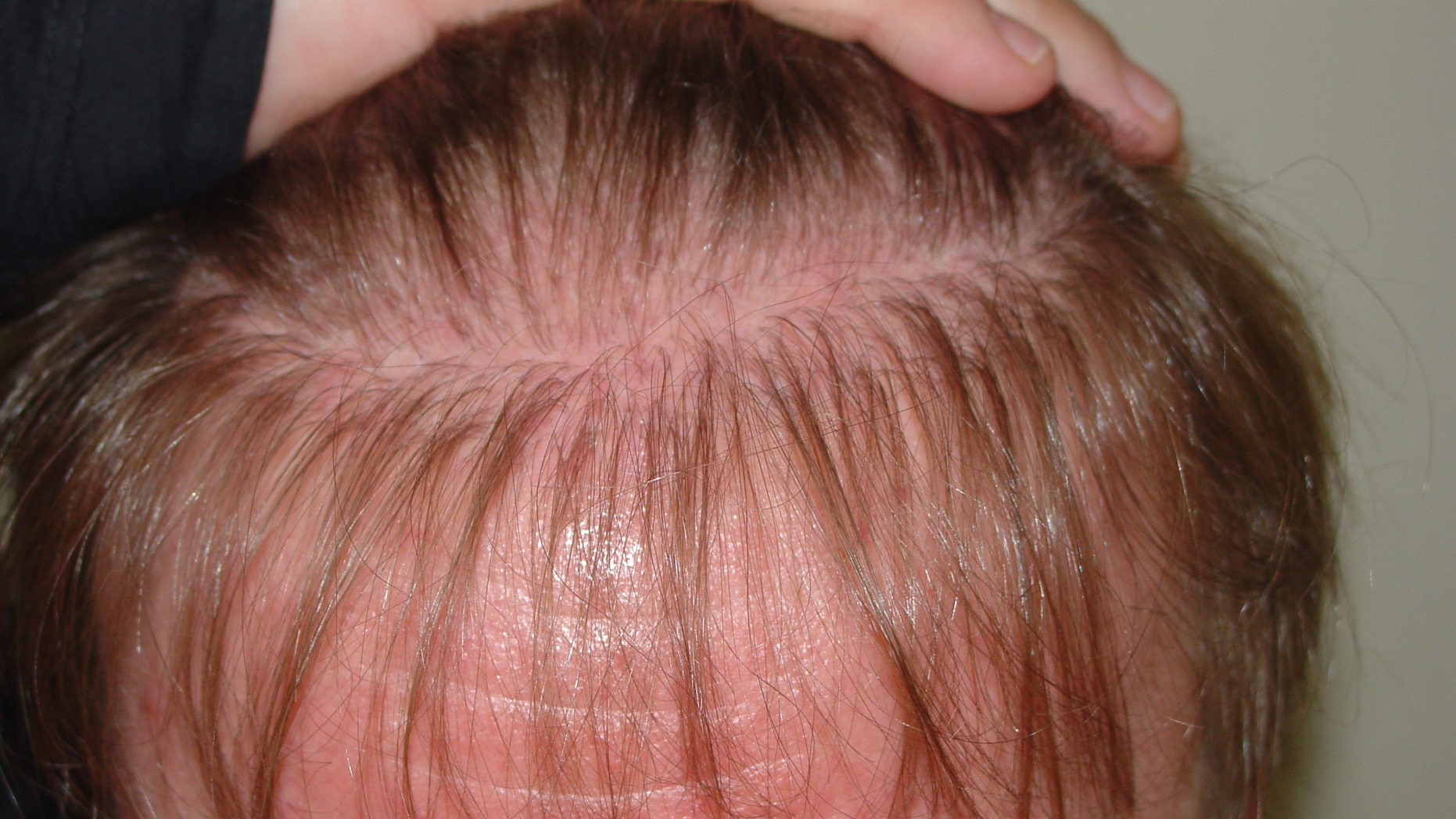 Hair Transplant Results Before And After Photo Gallery Bosley