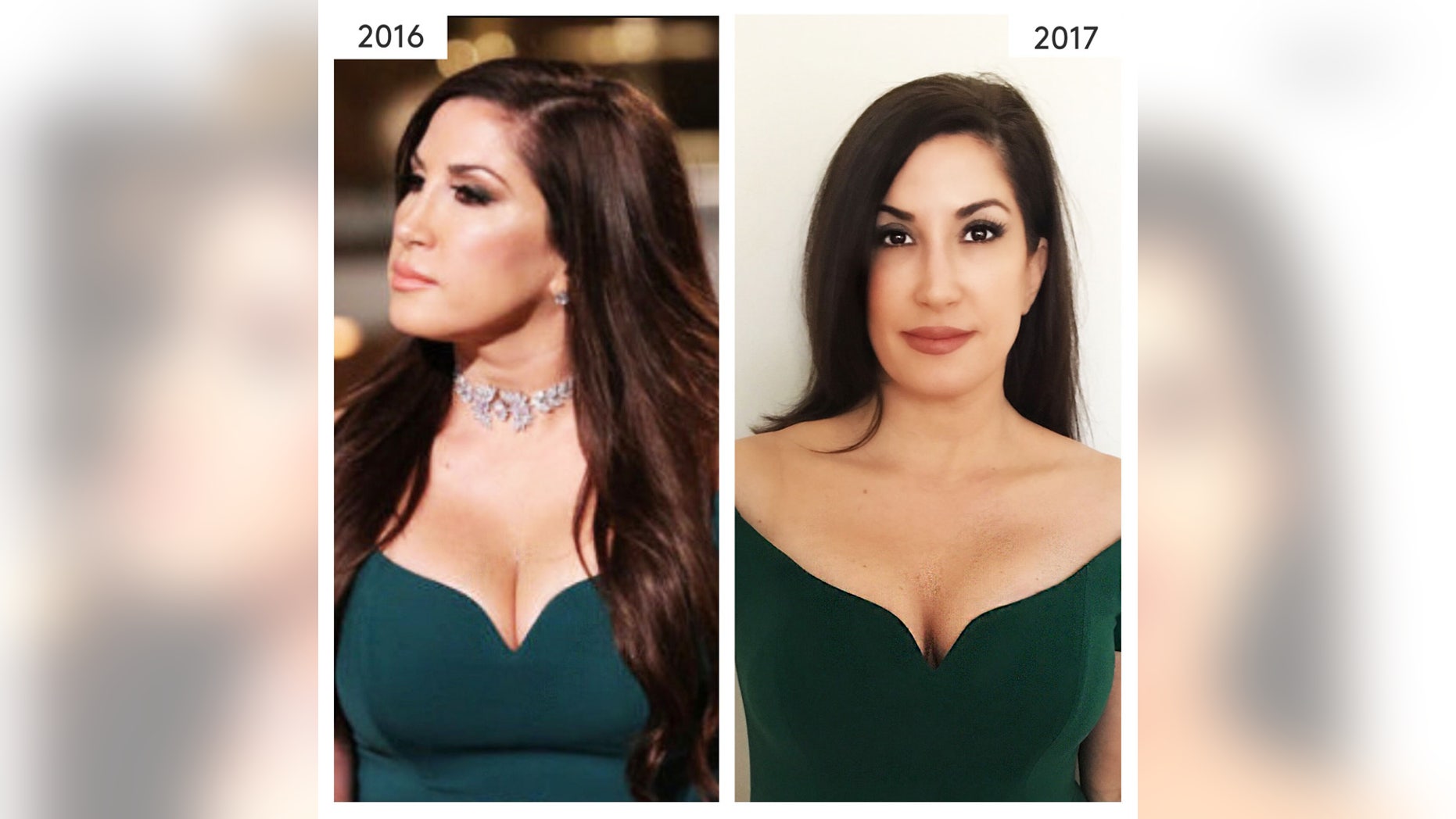 "Real Housewives of New Jersey" star Jacqueline Laurita's results after getting Ideal Implant.