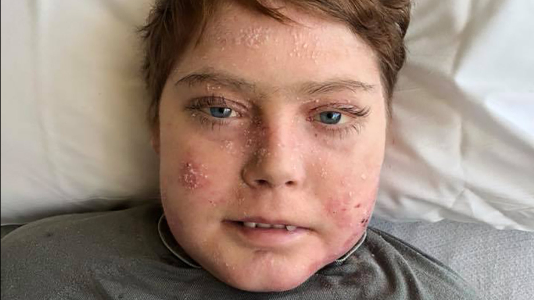 Jonathan Pitre died after suffering from a rare skin disease that gave him the nickname "butterfly boy."