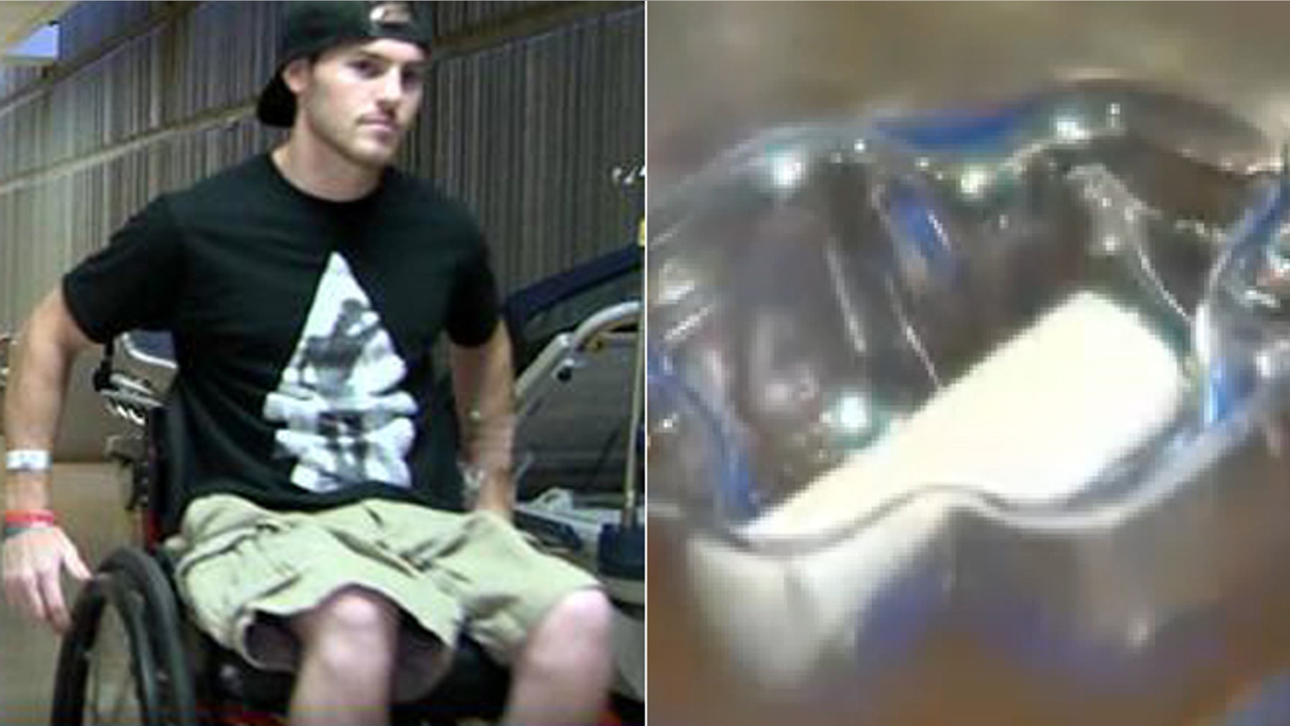 Left, 25-year-old Jordan Fellis is confined to a wheelchair after a dirt bike accident severed his spine. Right, a zoomed in photo of a device doctors hope will heal his spinal cord and help him to walk again.