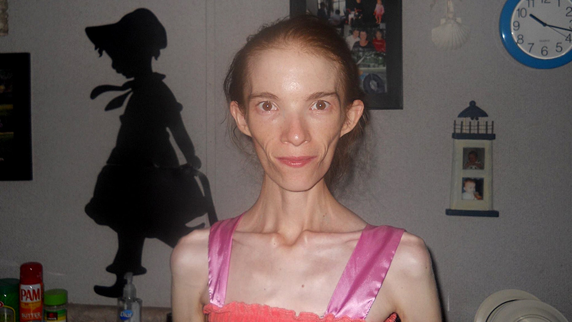 Anorexic Woman Is Given Choice To Seek Out-of-state Medical Treatment ...