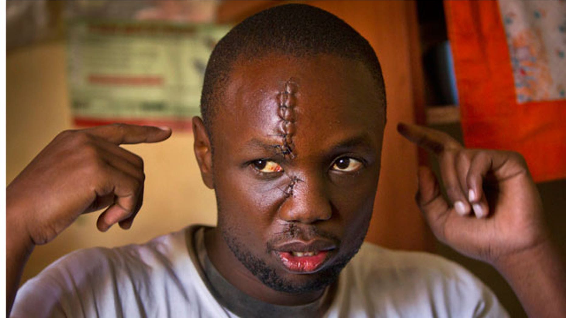 Jan. 31, 2012: Kenyan Anthony Omari, 24, describes the attack during which he suffered a machete slash to the face while defending one of Kenya's under-resourced orphanages from a half dozen machete-wielding thugs.