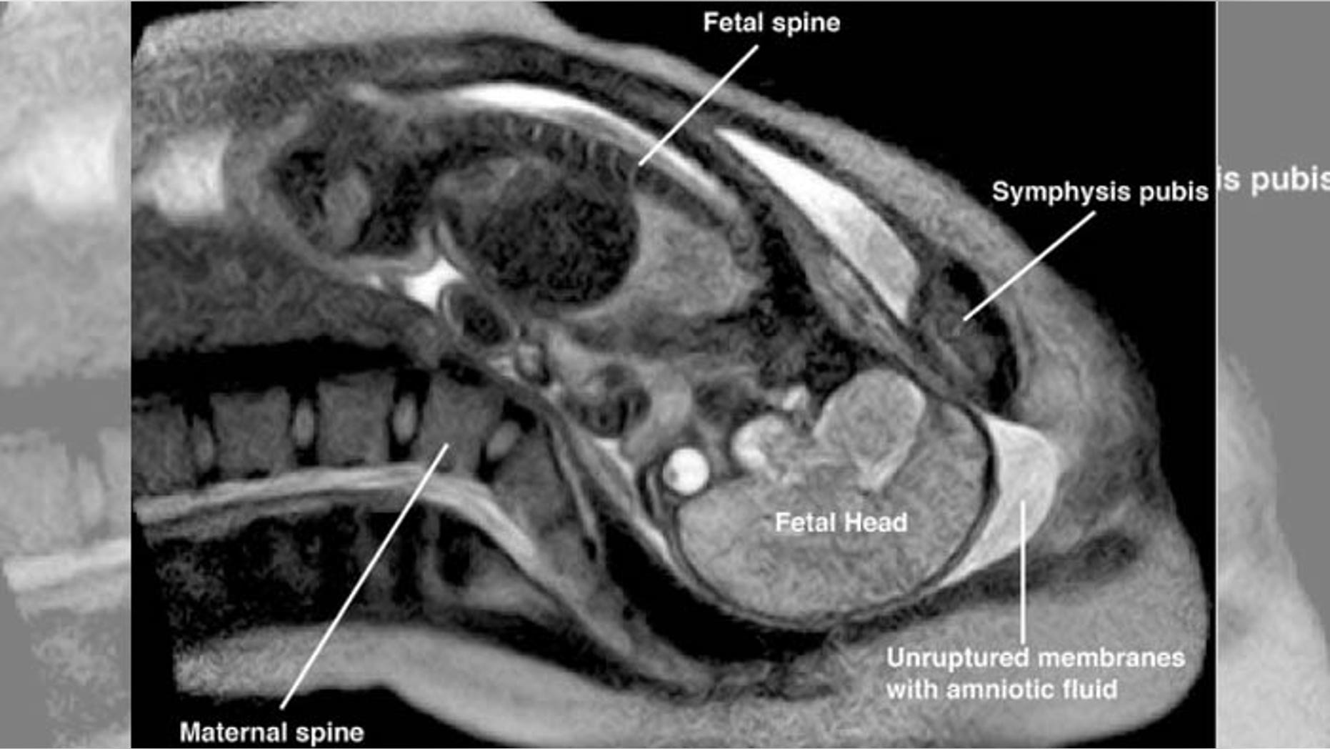 Imaging of gynecological disorders in infants and children
