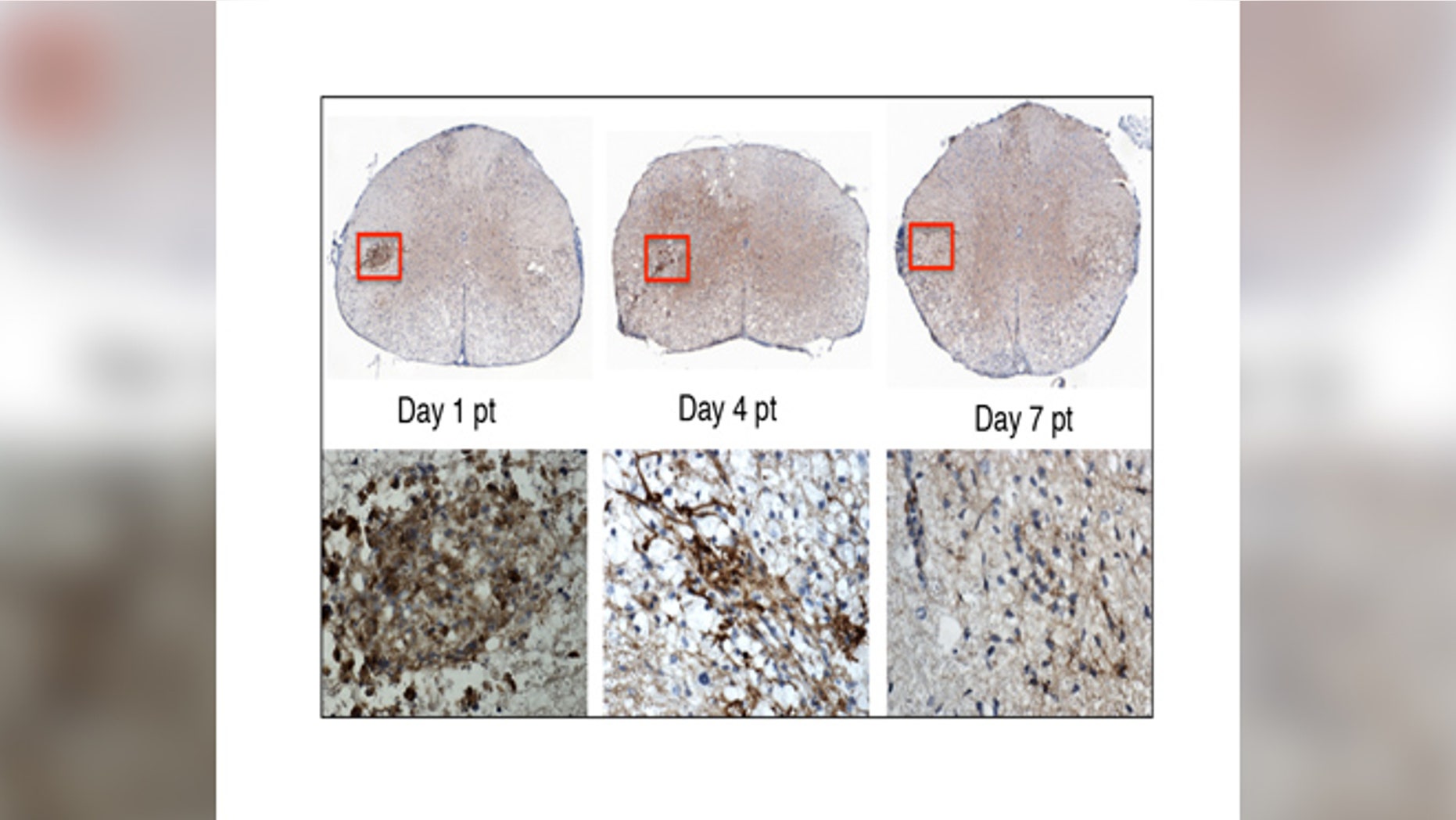 In this image, the top row shows the stem cells transplanted into the mouse spinal cord. The lower row shows a close-up of the stem cells (brown). By day 7 post-transplant, the stem cells are no longer detectable. Within this short period of time, the stem cells have sent chemical signals to the mouse’s own cells, enabling them to repair the nerve damage caused by MS. (image: Lu Chen)