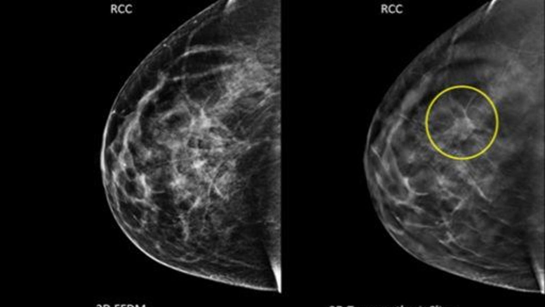 This undated combination provided by Hologic shows an image taken using conventional mammography, left, and an image using a 3D mammography, right, with a tumor circled that wasn���t visible on the first image.