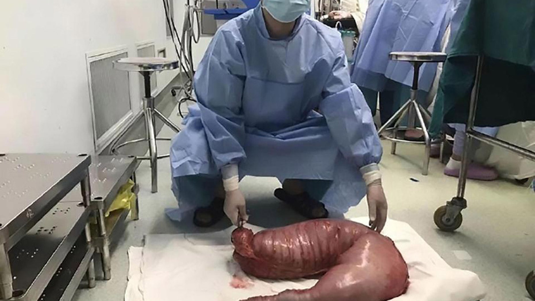 The section of colon that was removed was 30 inches long and weighed nearly 29 lbs.