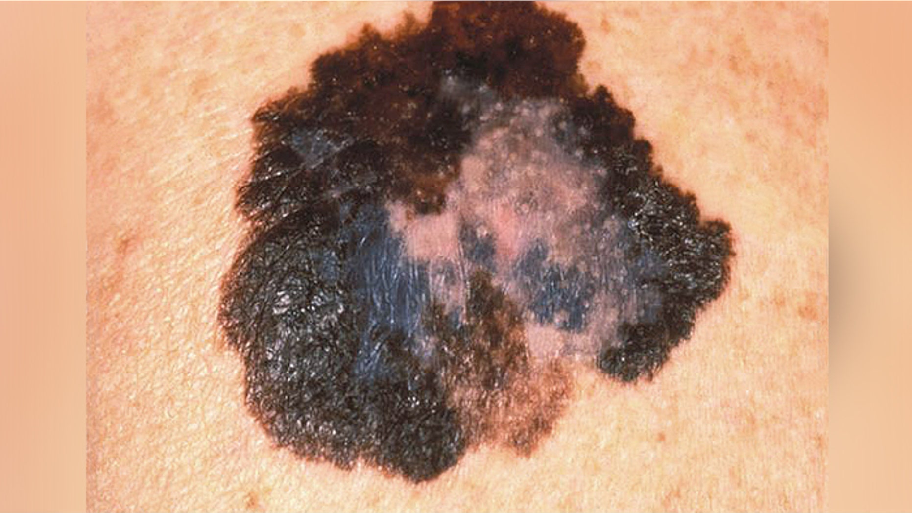 This image depicts the gross appearance of a cutaneous pigmented lesion, which had been diagnosed as superficial spreading malignant melanoma (SSMM).