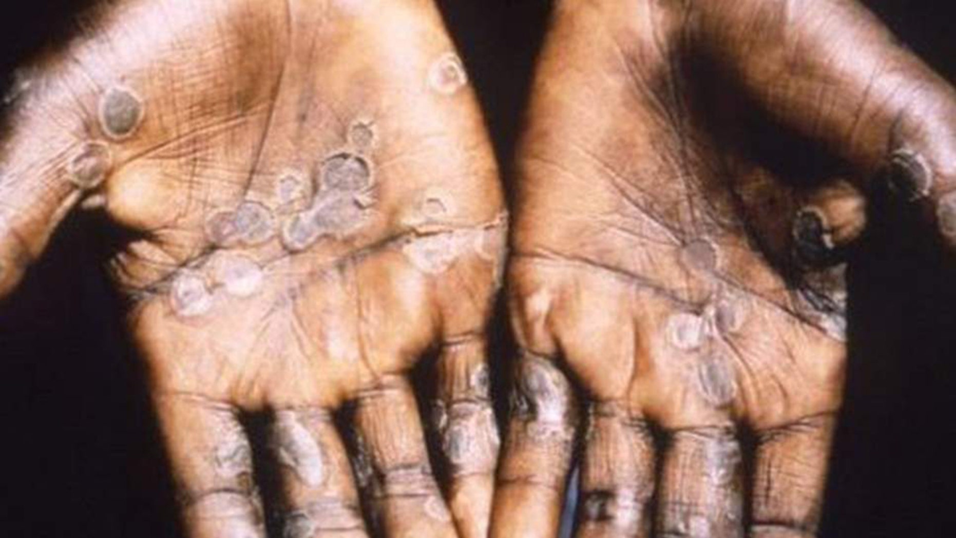 smallpox skin scar