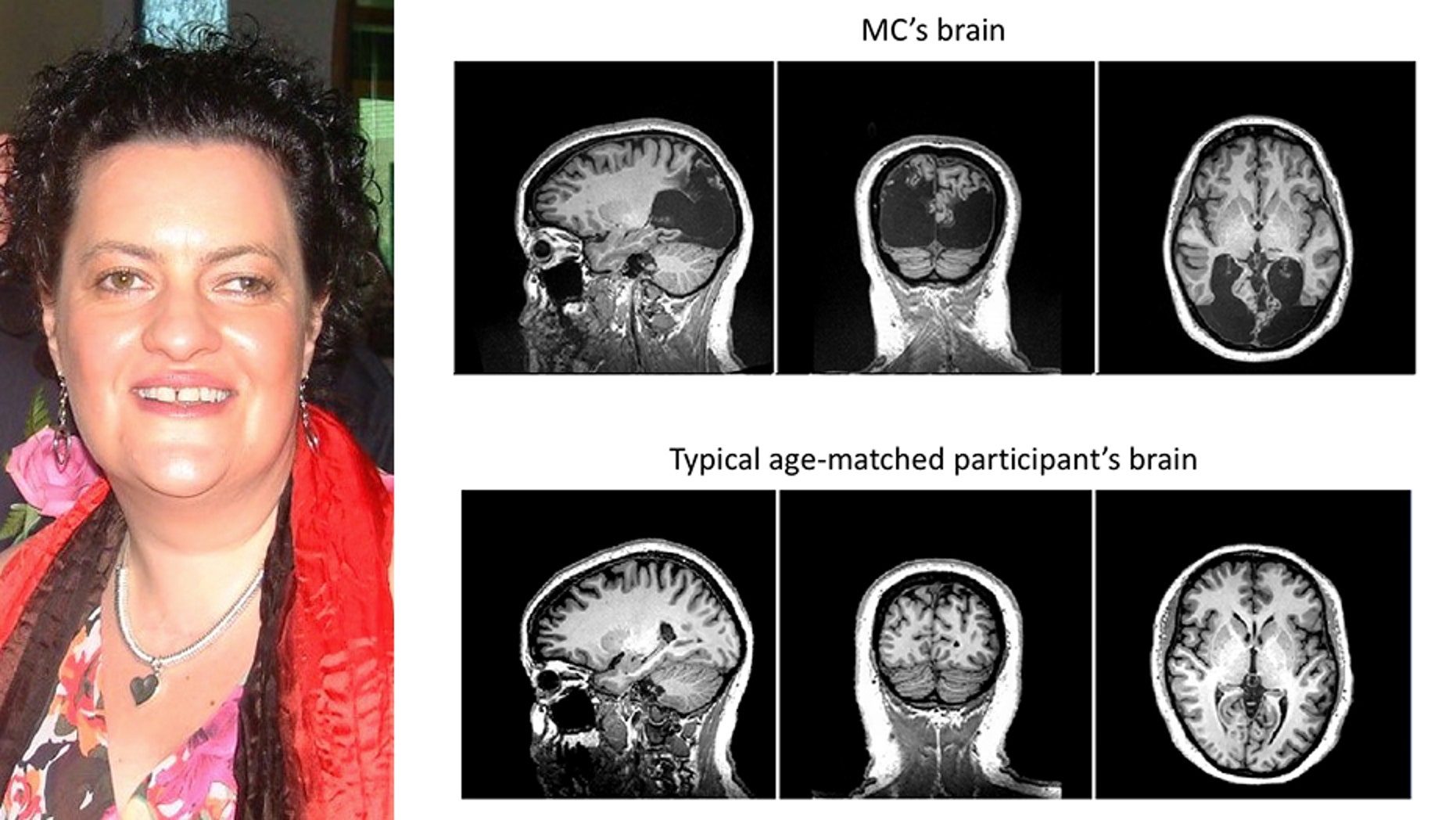 Milena Canning, 48, has been blind for nearly 18 years.