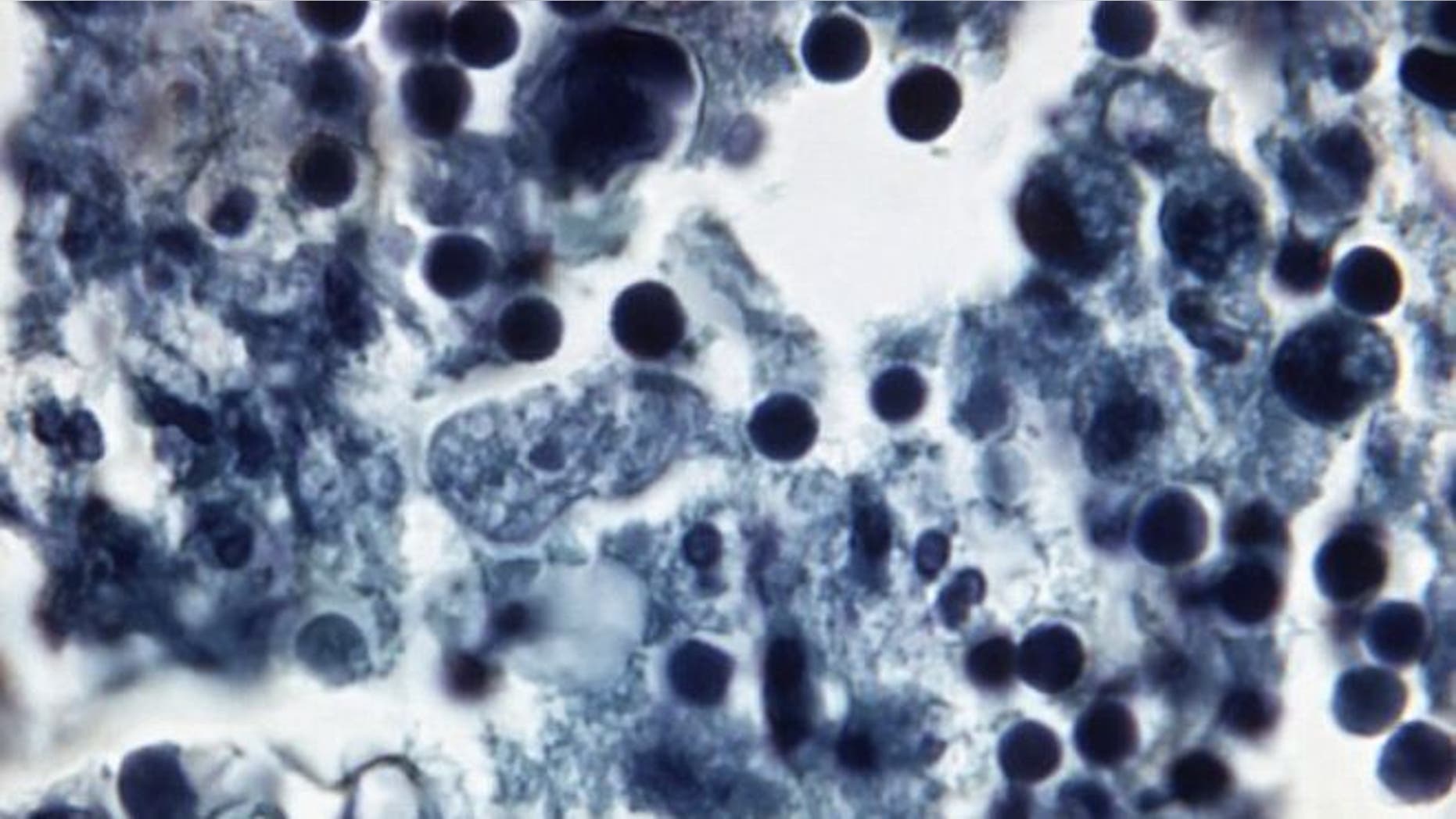 Naegleria fowleri in human brain tissue. (CDC.GOV)
