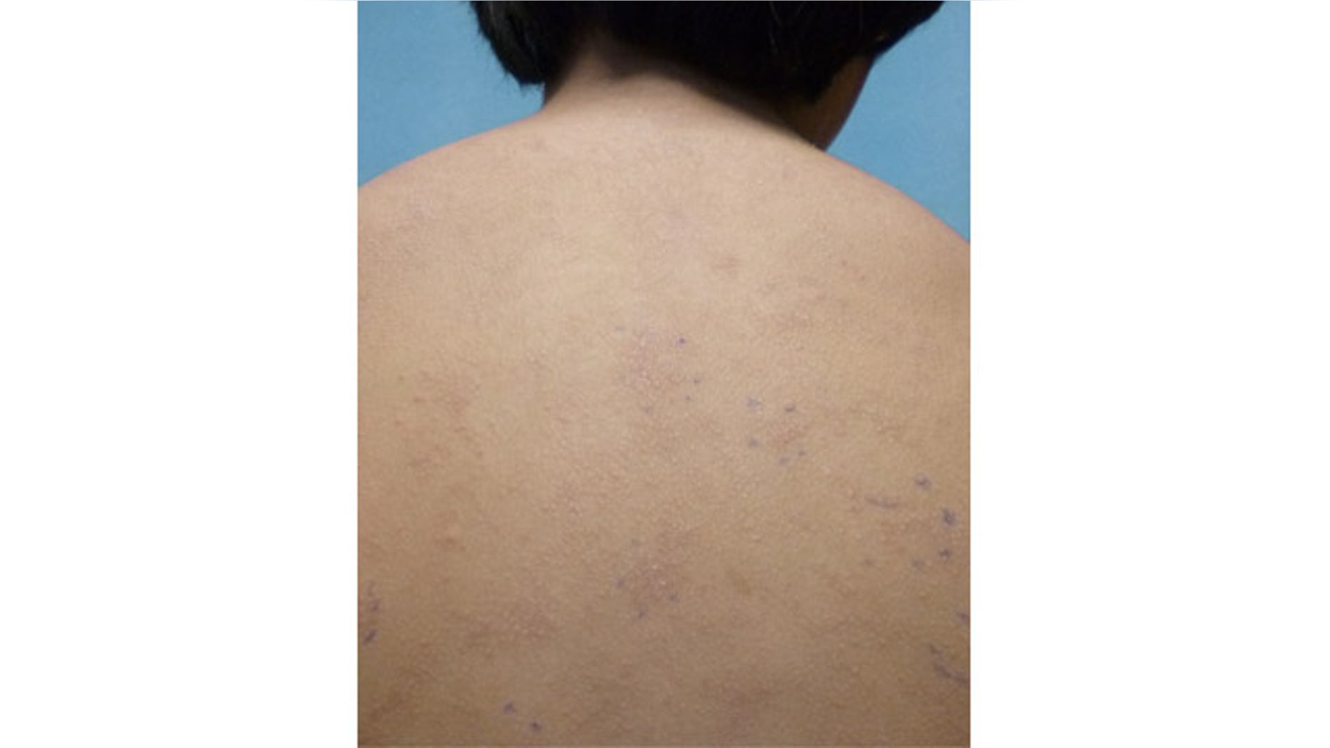 This undated photo provided by American Academy of Pediatrics shows a rash on an unidentified 11-year old boy from a nickel allergy. Case reports in medical journals detail nickel allergies from personal electronic devices, including laptops and cell phones. (AP Photo/American Academy of Pediatrics)