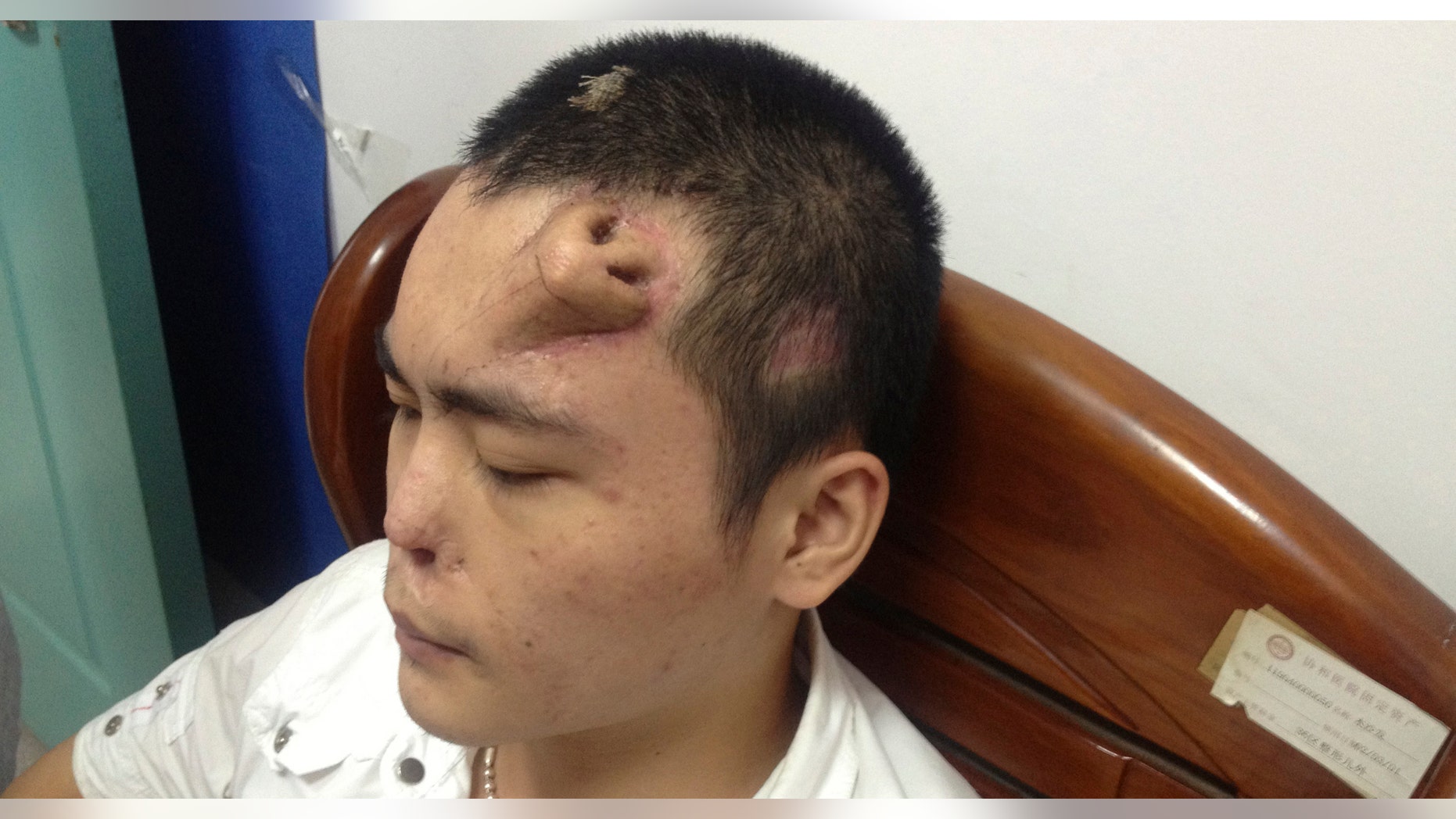 A new nose, grown by surgeons on Xiaolian's forehead, is pictured before being transplanted to replace the original nose, which is infected and deformed, at a hospital in Fuzhou, Fujian province.