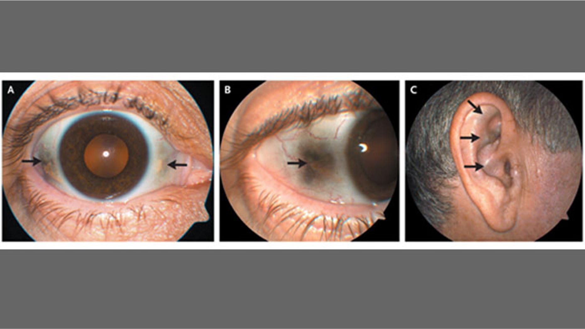 The eyes and ear cartilage of an unnamed patient suffering from ochronosis.