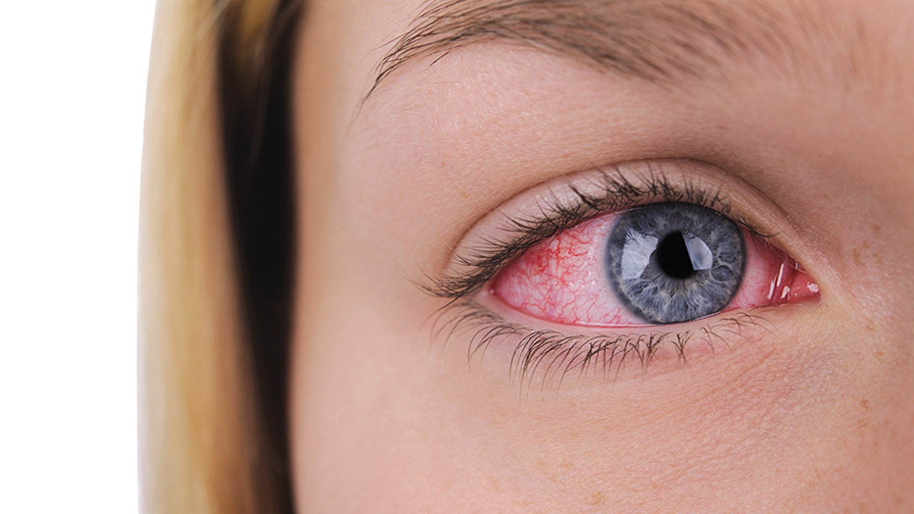 Texas doctor warns 'super strain' of pink eye on rise in part of state