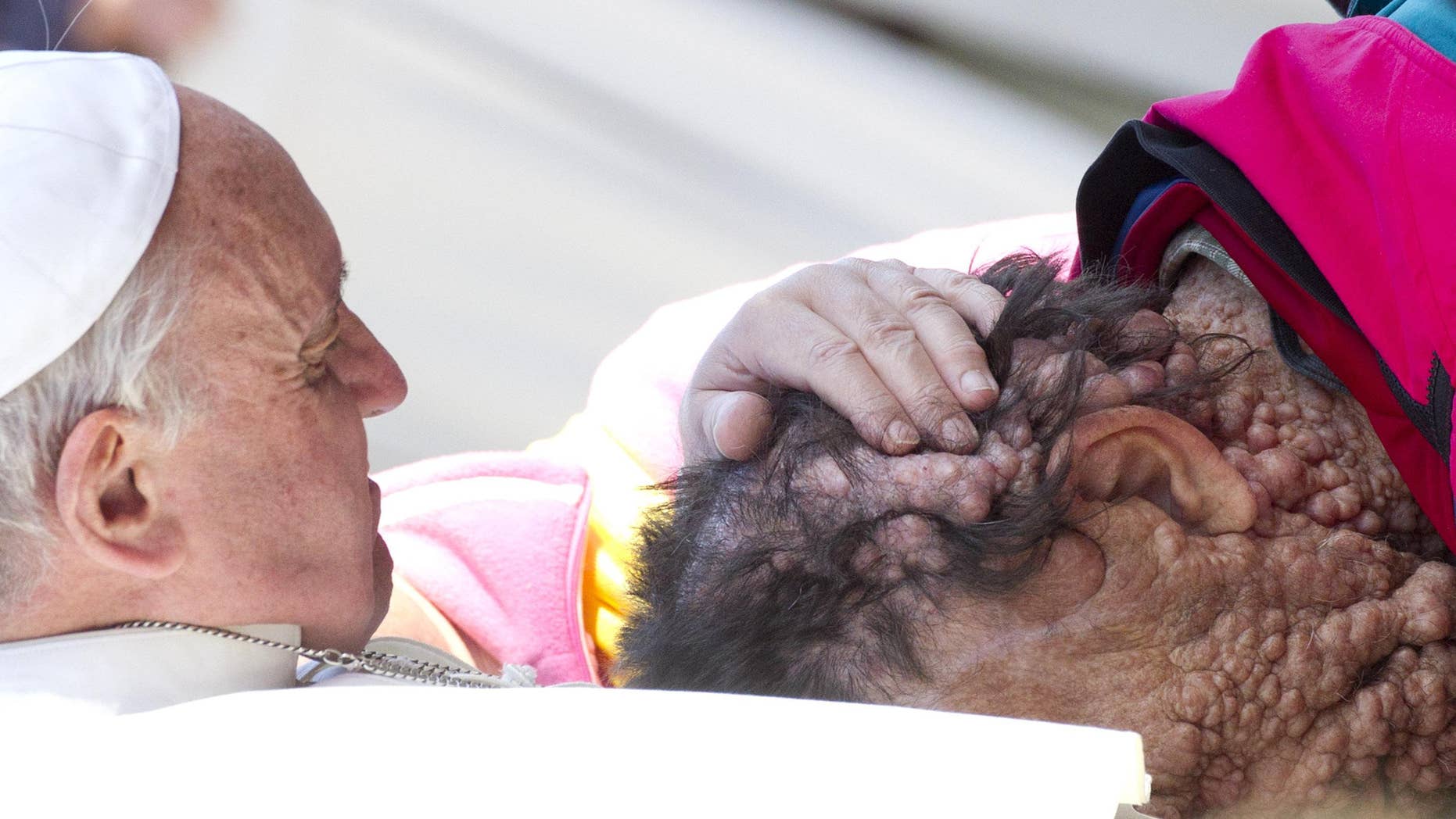 Pope Francis embraced a man whose genetic disorder causes tumors on his head, in a powerful moment that went viral. (EPA/CLAUDIO PERI)