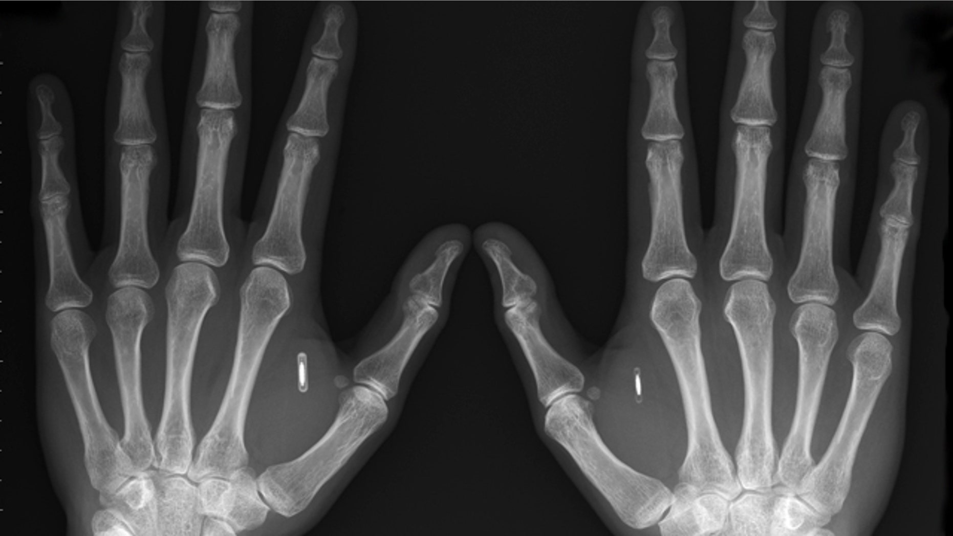 Tech enthusiasts and futurists think implantable radio chips, such as those embedded in Amal Graafstra's hands, could mean safety, security and convenience. But civil libertarians are concerned about privacy.