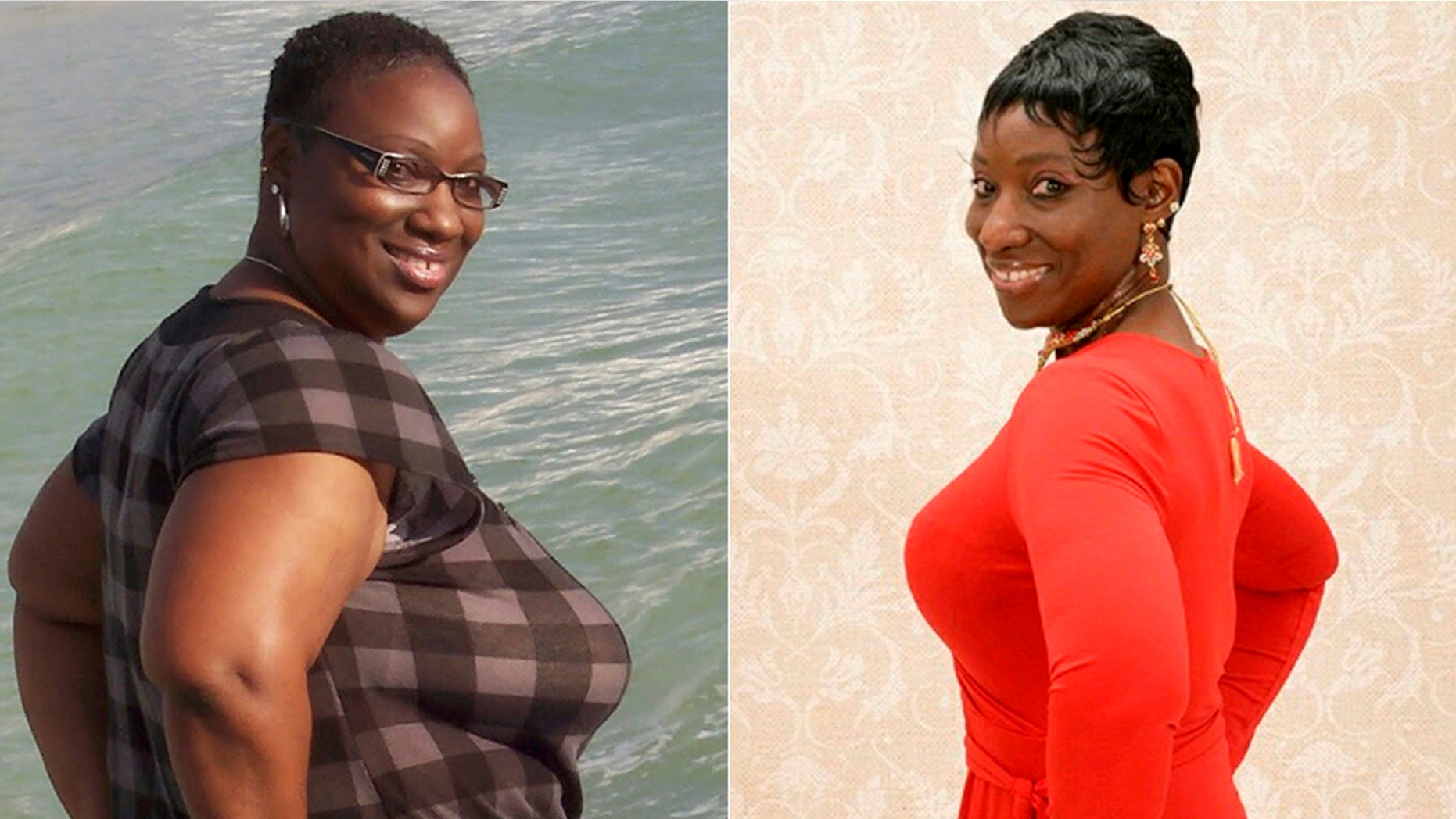 A 50-year old woman told SWNS that when lost 150 pounds, she was able to get rid of a chronic skin problem called Hidradenitis Suppurativa.