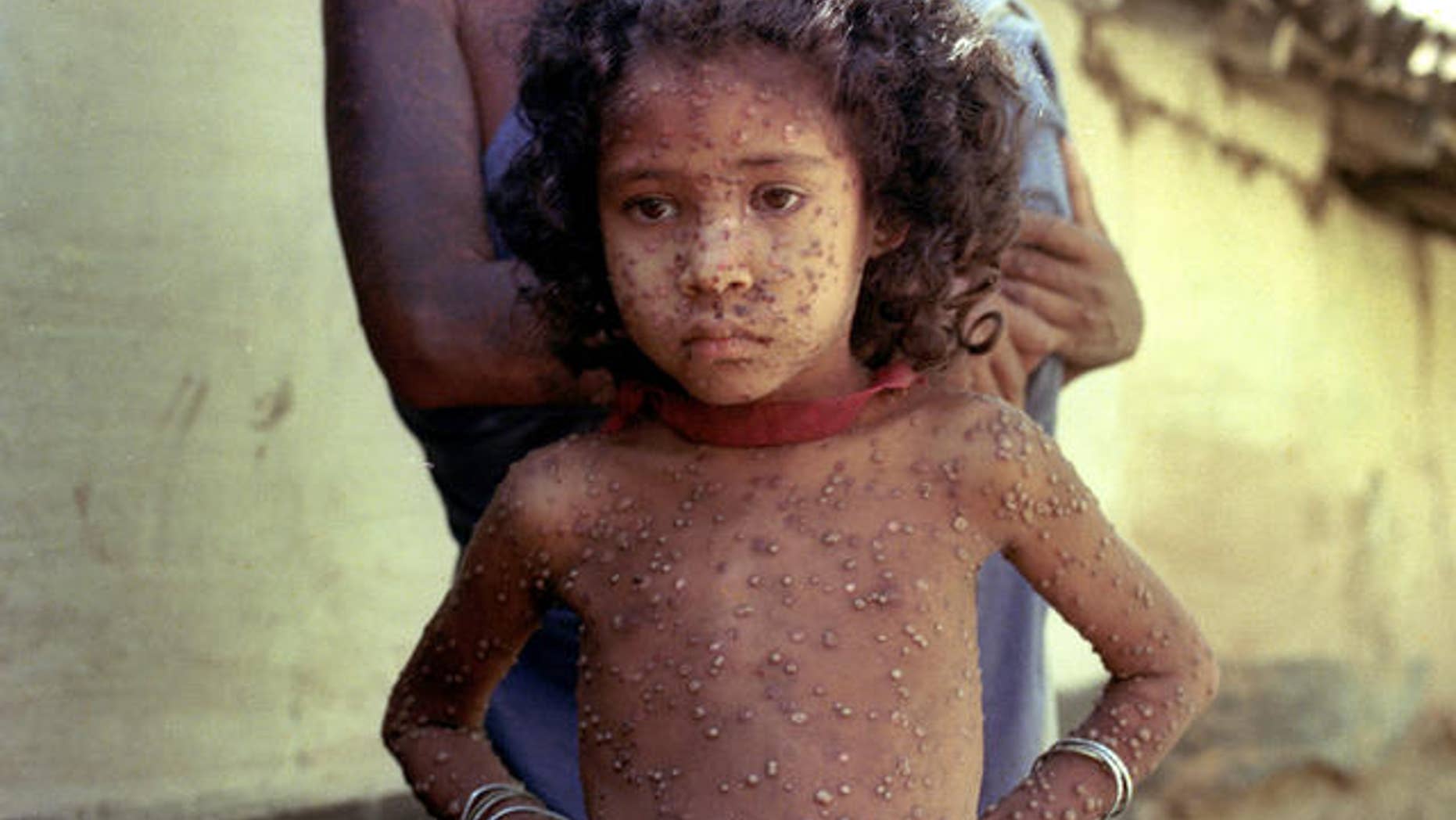A child affected by the smallpox virus.