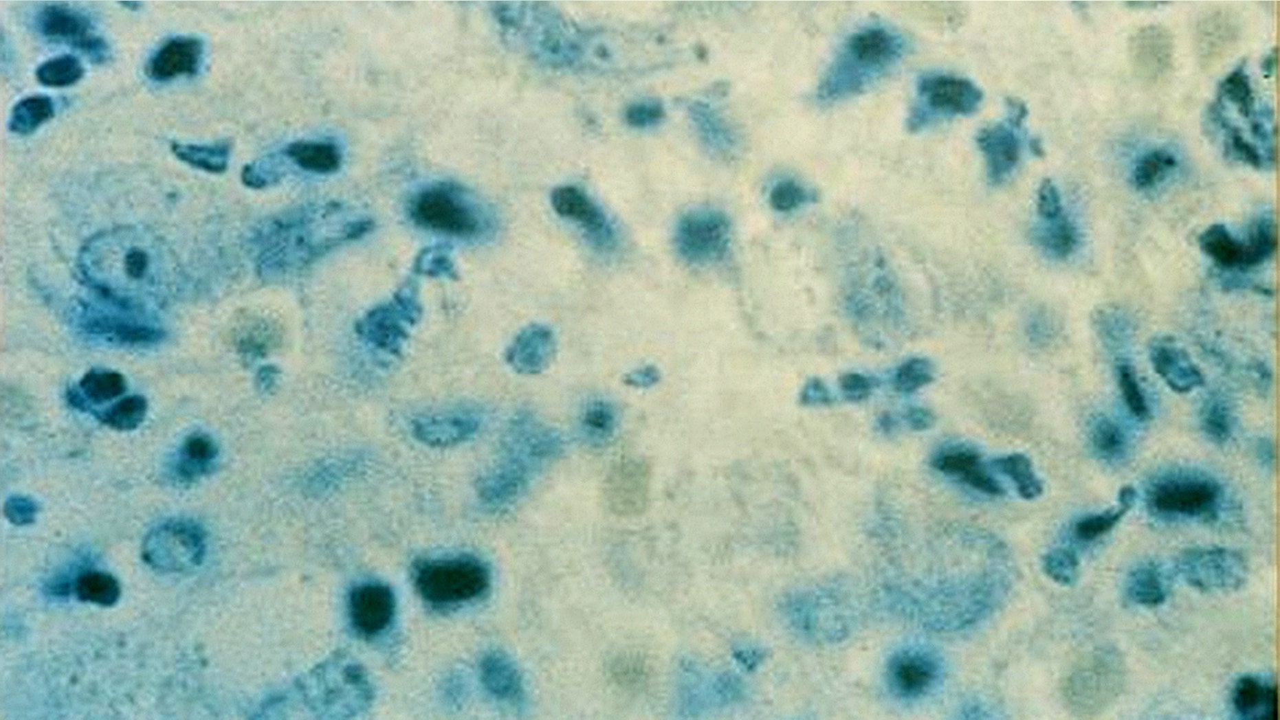 An unnamed female patient, who lives in Southport and is between the ages of 15 and 25, reportedly was diagnosed with donovanosis within the last 12 months.