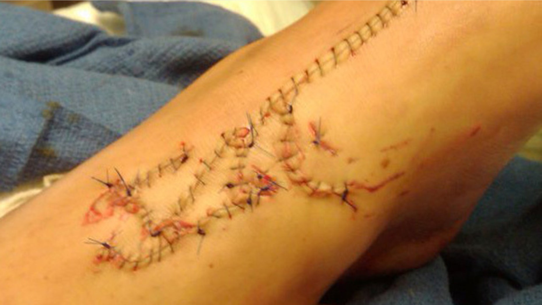 Carley Schlentz, 13, of Greensboro, was swimming with friends at Topsail Island on Friday when she bitten by a shark twice near the top of her left foot. (Fox8.com)